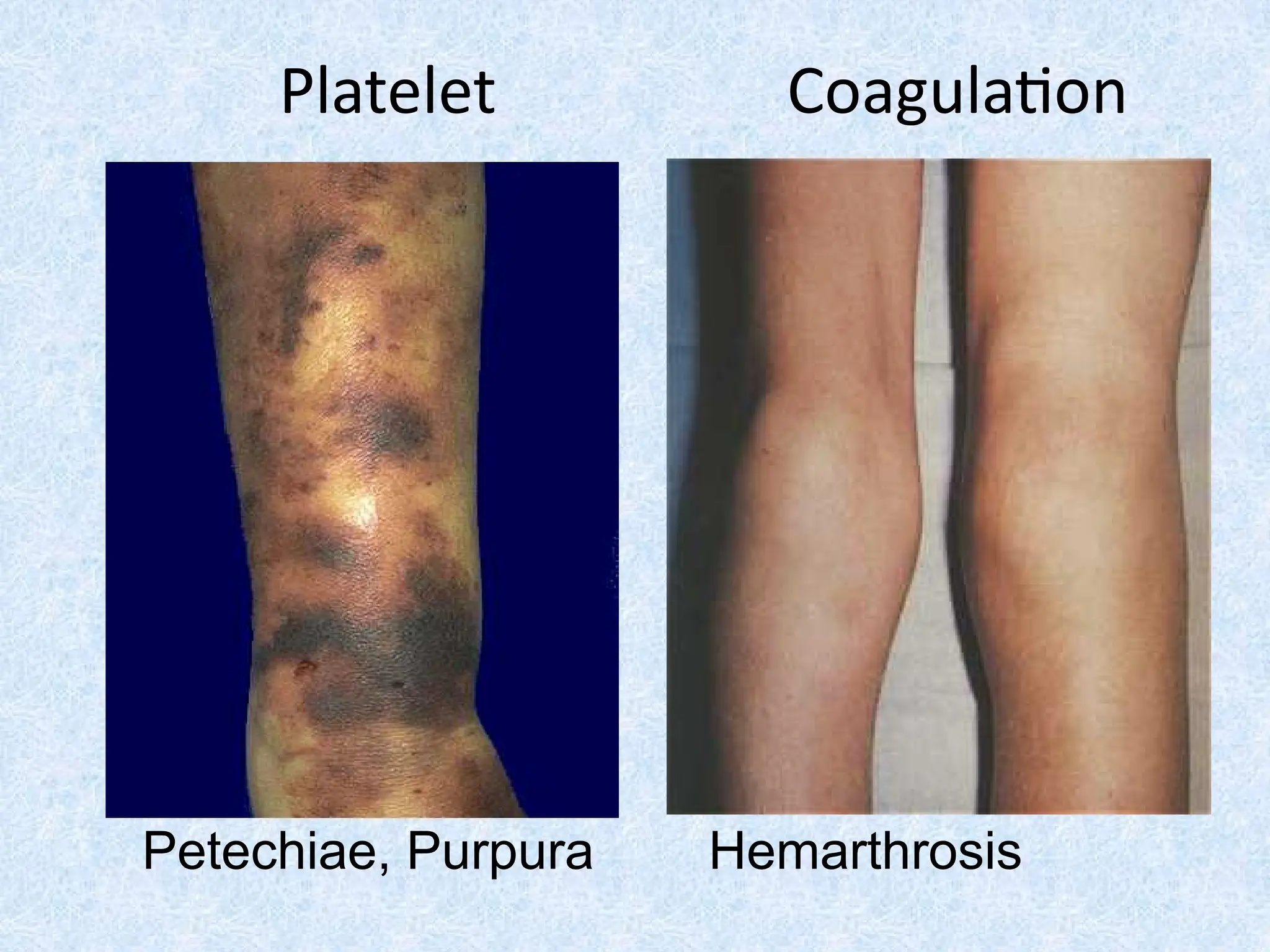 Platelet Coagulation
Petechiae, Purpura Hemarthrosis
 