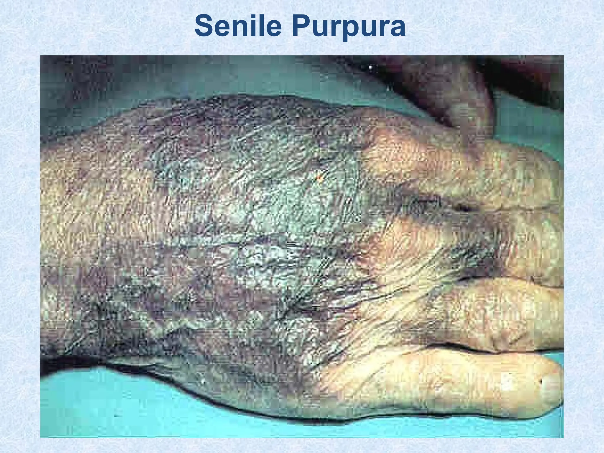 Senile Purpura
 