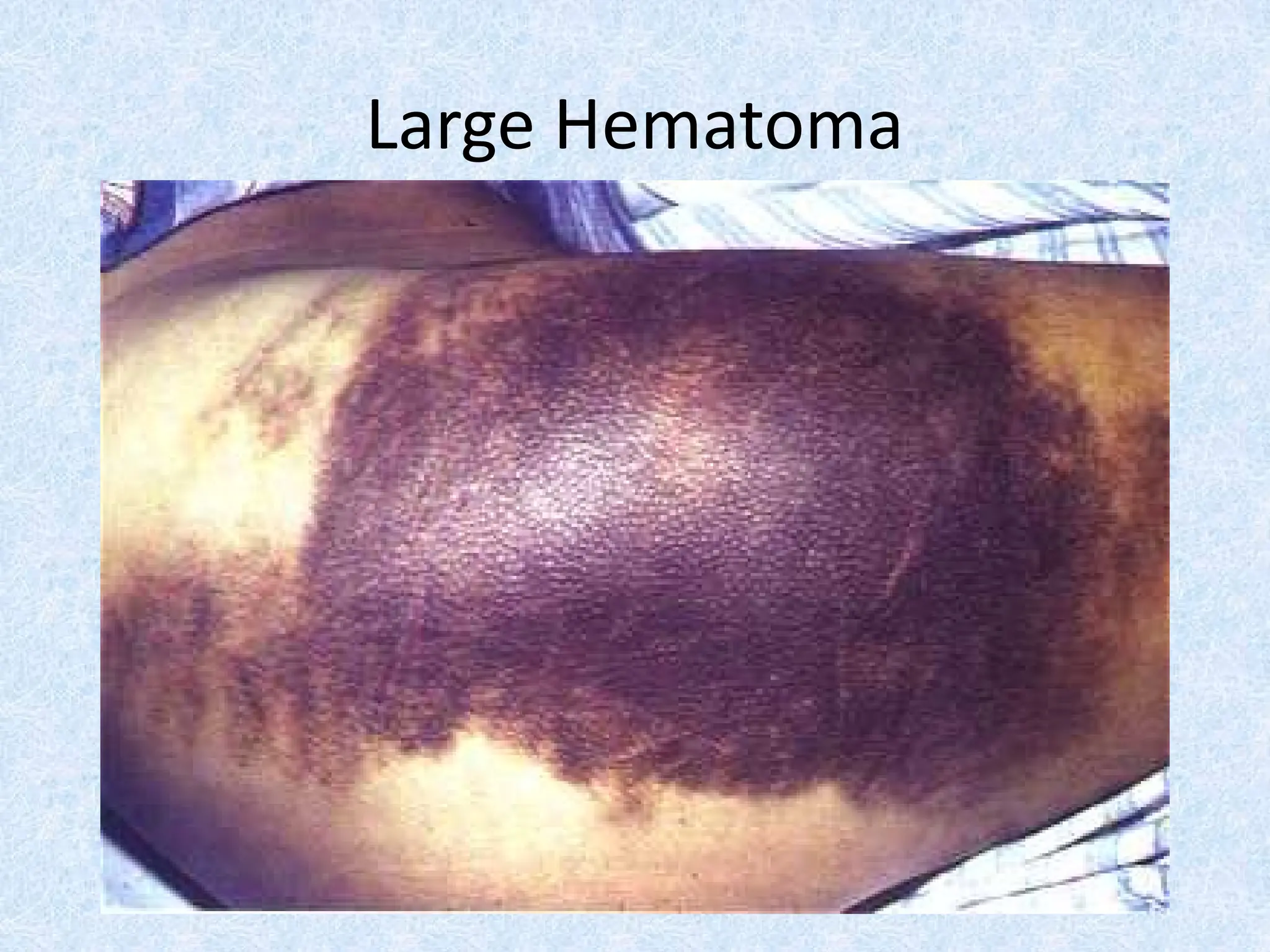 Large Hematoma
 