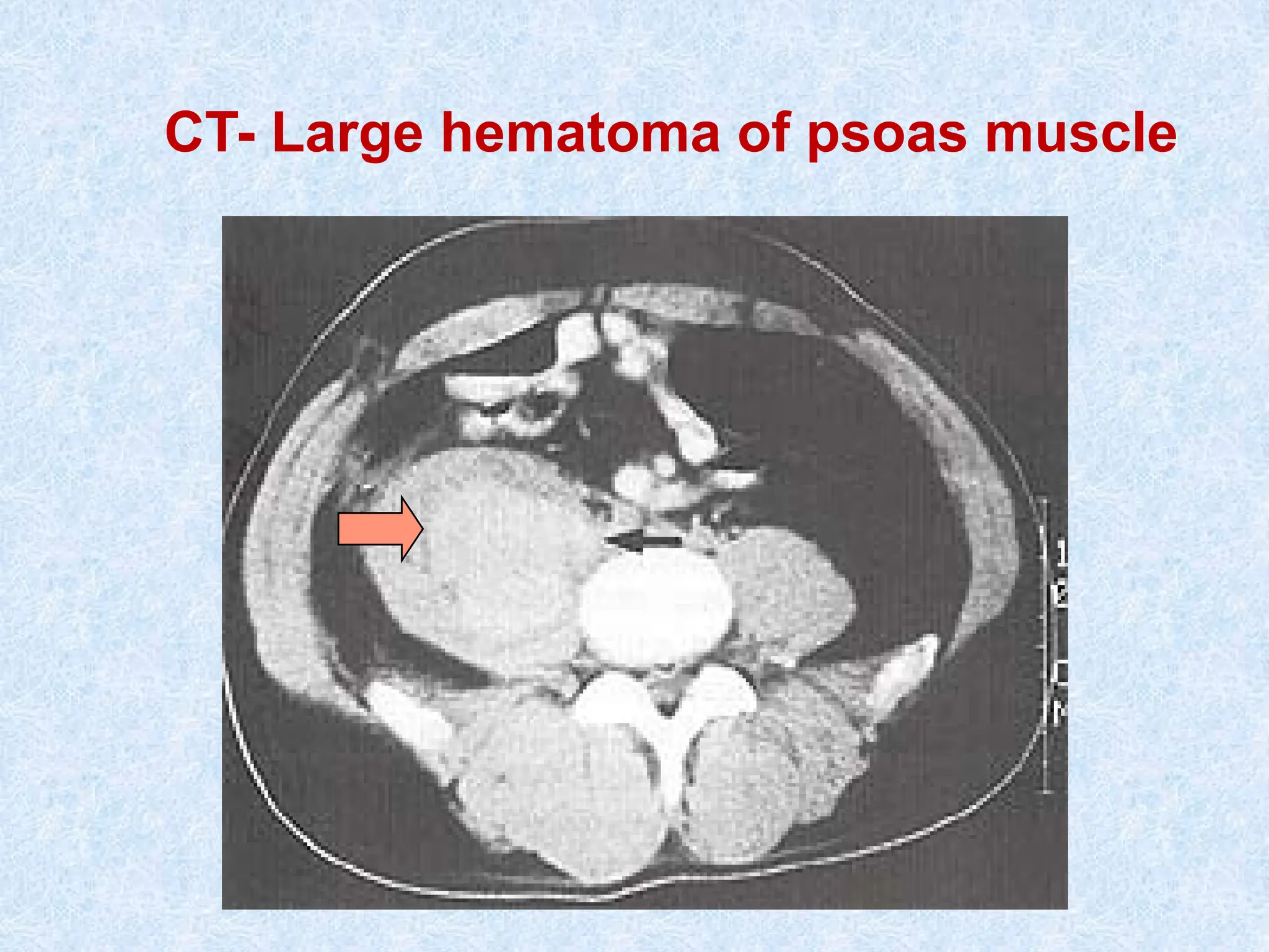 CT- Large hematoma of psoas muscle
 