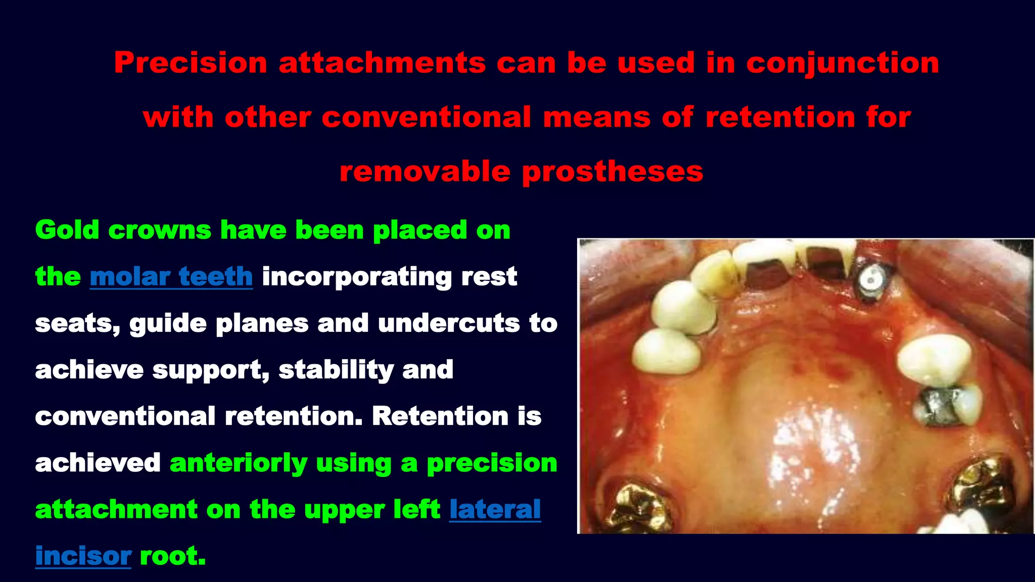Precision attachments can be used in conjunction
with other conventional means of retention for
removable prostheses
Gold crowns have been placed on
the molar teeth incorporating rest
seats, guide planes and undercuts to
achieve support, stability and
conventional retention. Retention is
achieved anteriorly using a precision
attachment on the upper left lateral
incisor root.
 