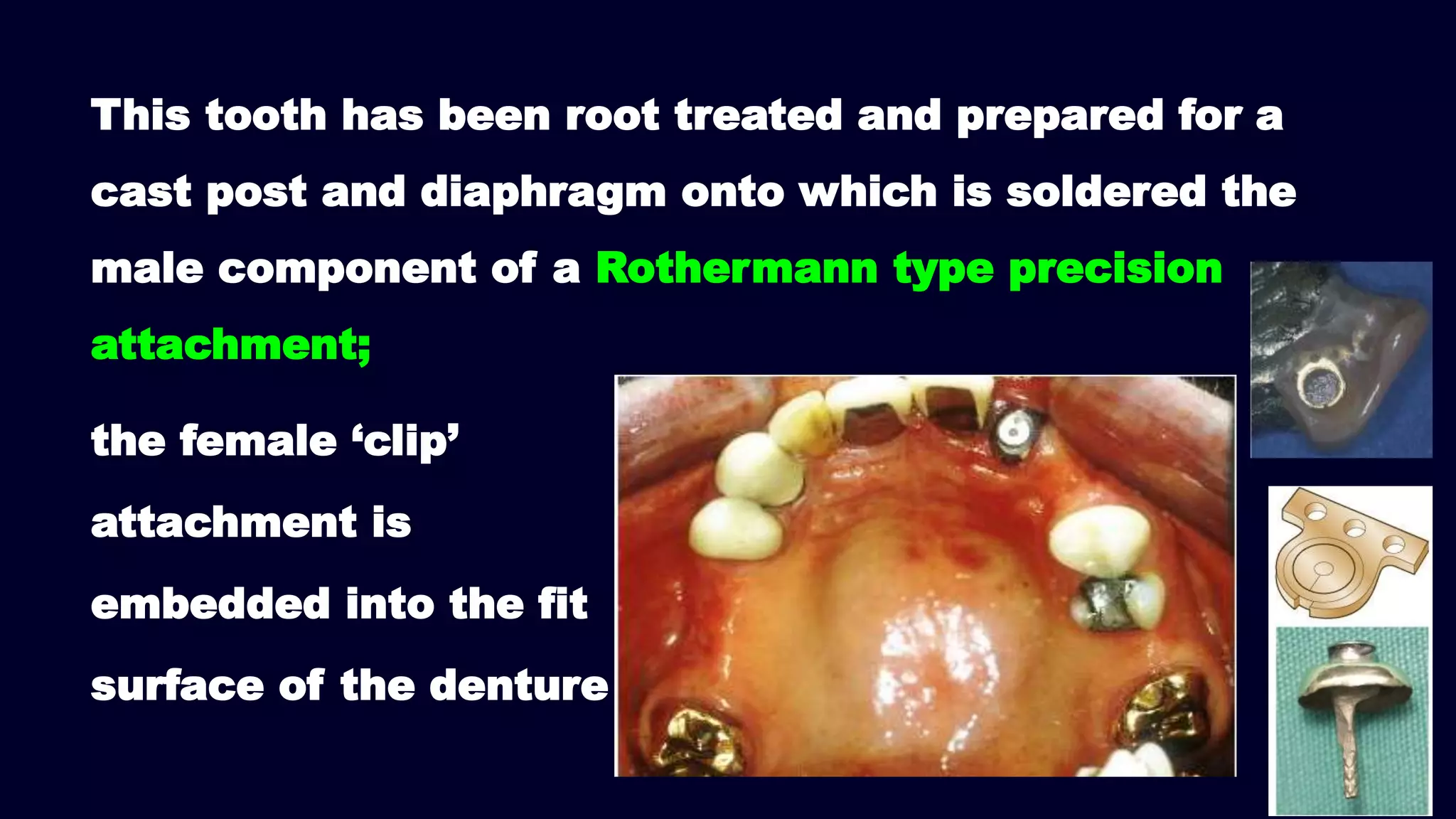 the female ‘clip’
attachment is
embedded into the fit
surface of the denture
This tooth has been root treated and prepared for a
cast post and diaphragm onto which is soldered the
male component of a Rothermann type precision
attachment;
 