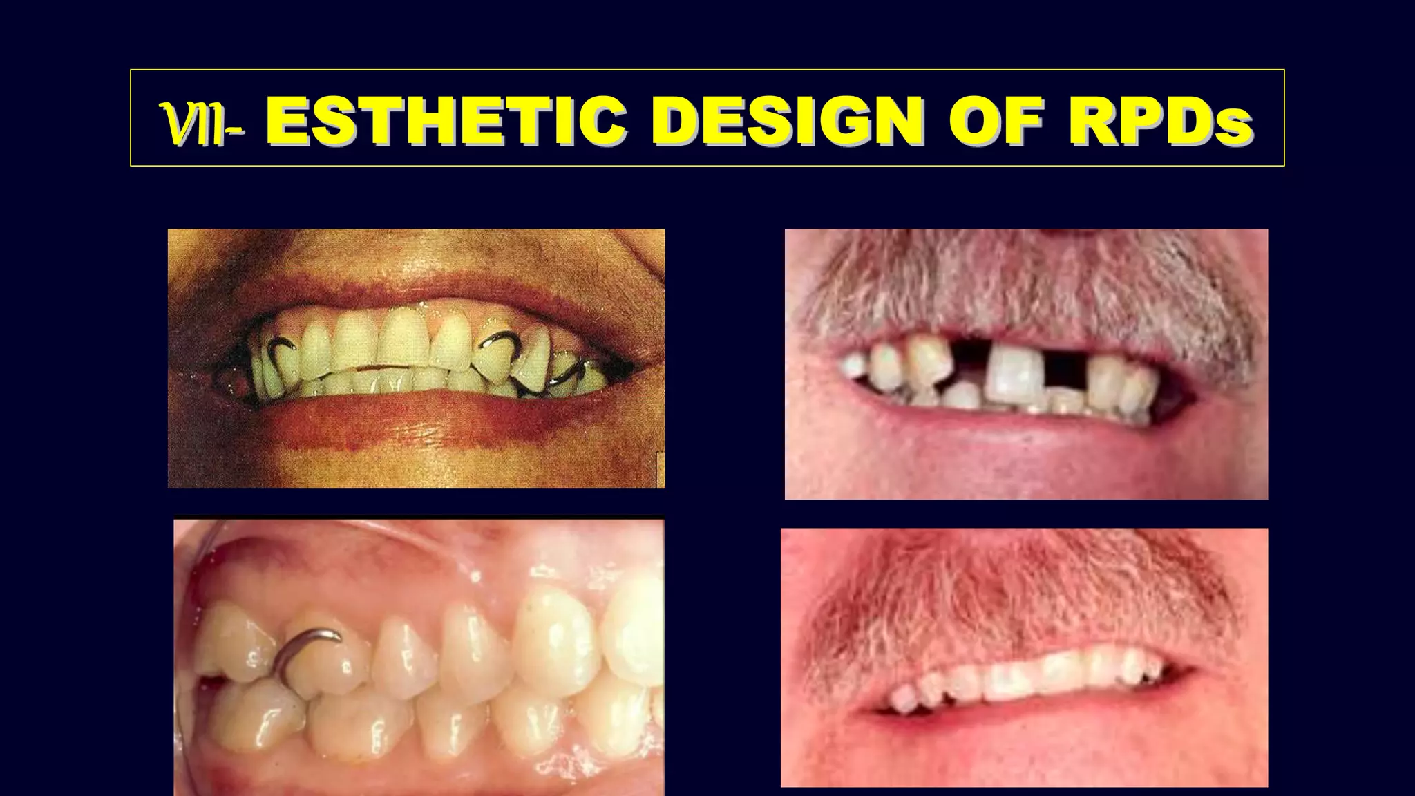 VII- ESTHETIC DESIGN OF RPDs
 