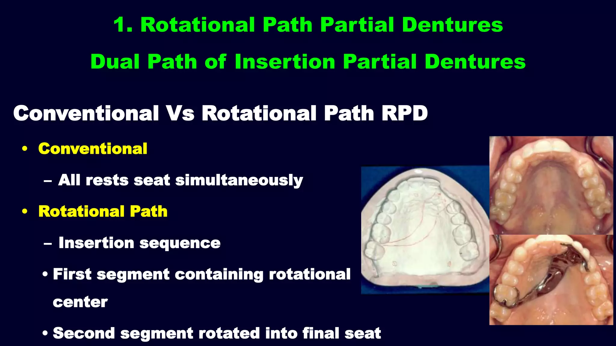1. Rotational Path Partial Dentures
Dual Path of Insertion Partial Dentures
• Conventional
– All rests seat simultaneously
• Rotational Path
– Insertion sequence
• First segment containing rotational
center
• Second segment rotated into final seat
Conventional Vs Rotational Path RPD
 