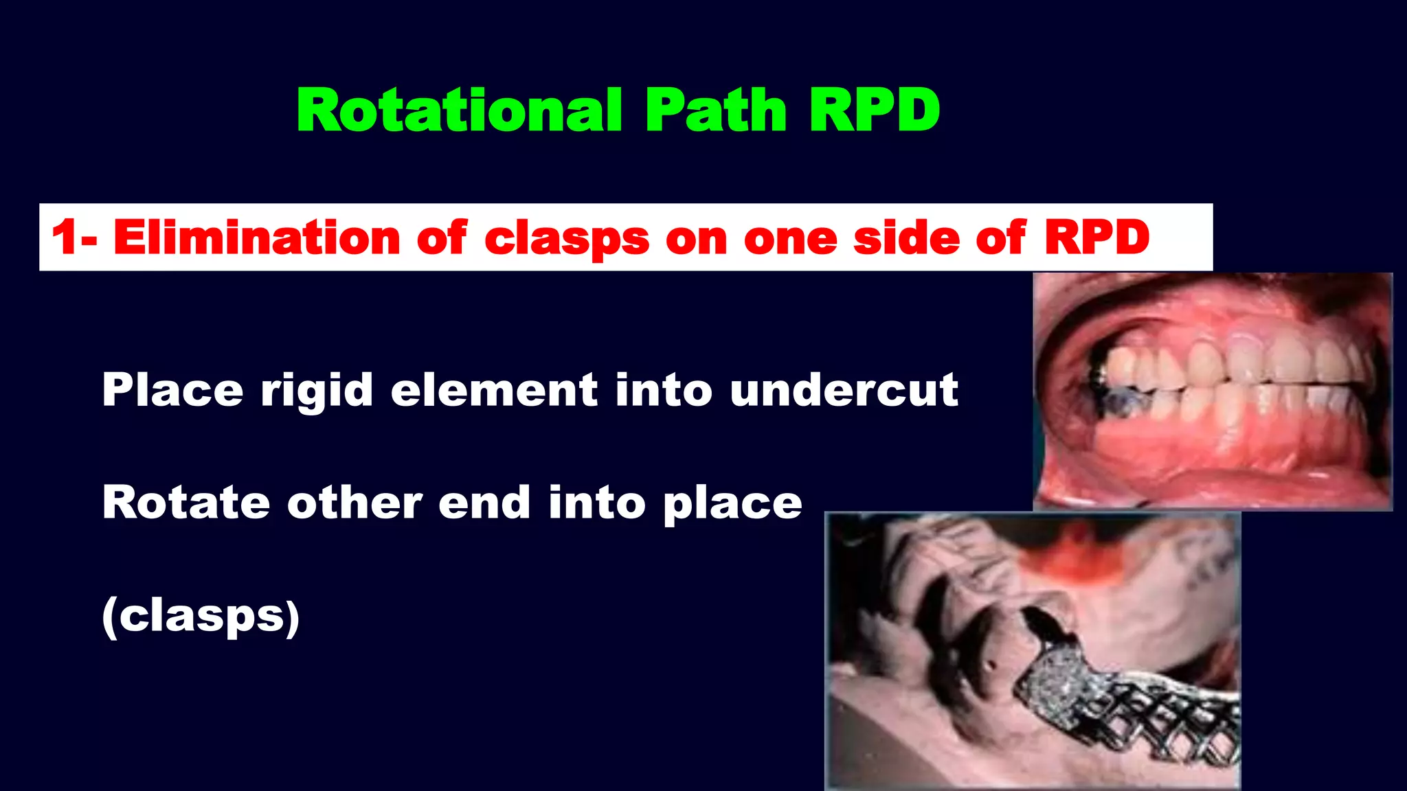 Place rigid element into undercut
Rotate other end into place
(clasps)
Rotational Path RPD
1- Elimination of clasps on one side of RPD
 