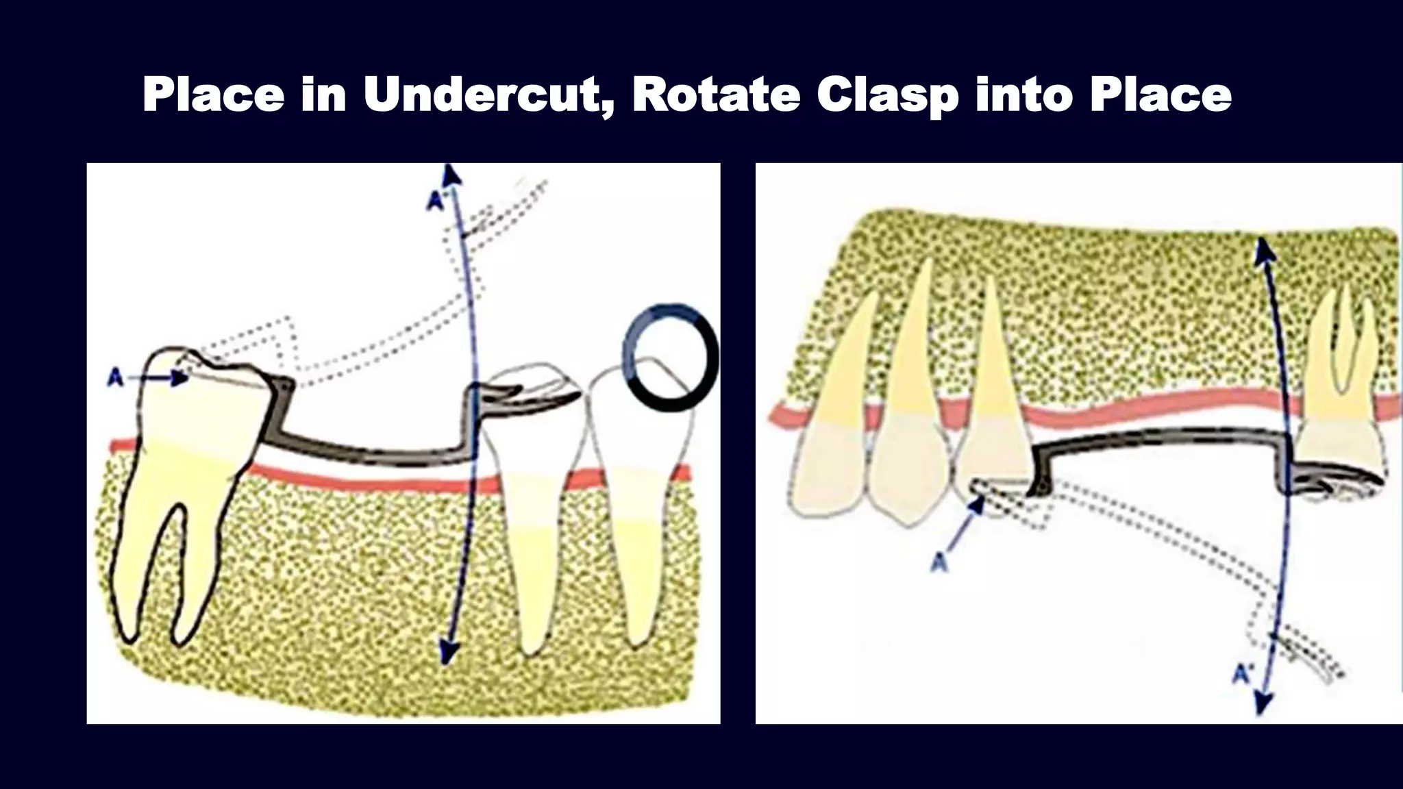 Place in Undercut, Rotate Clasp into Place
 