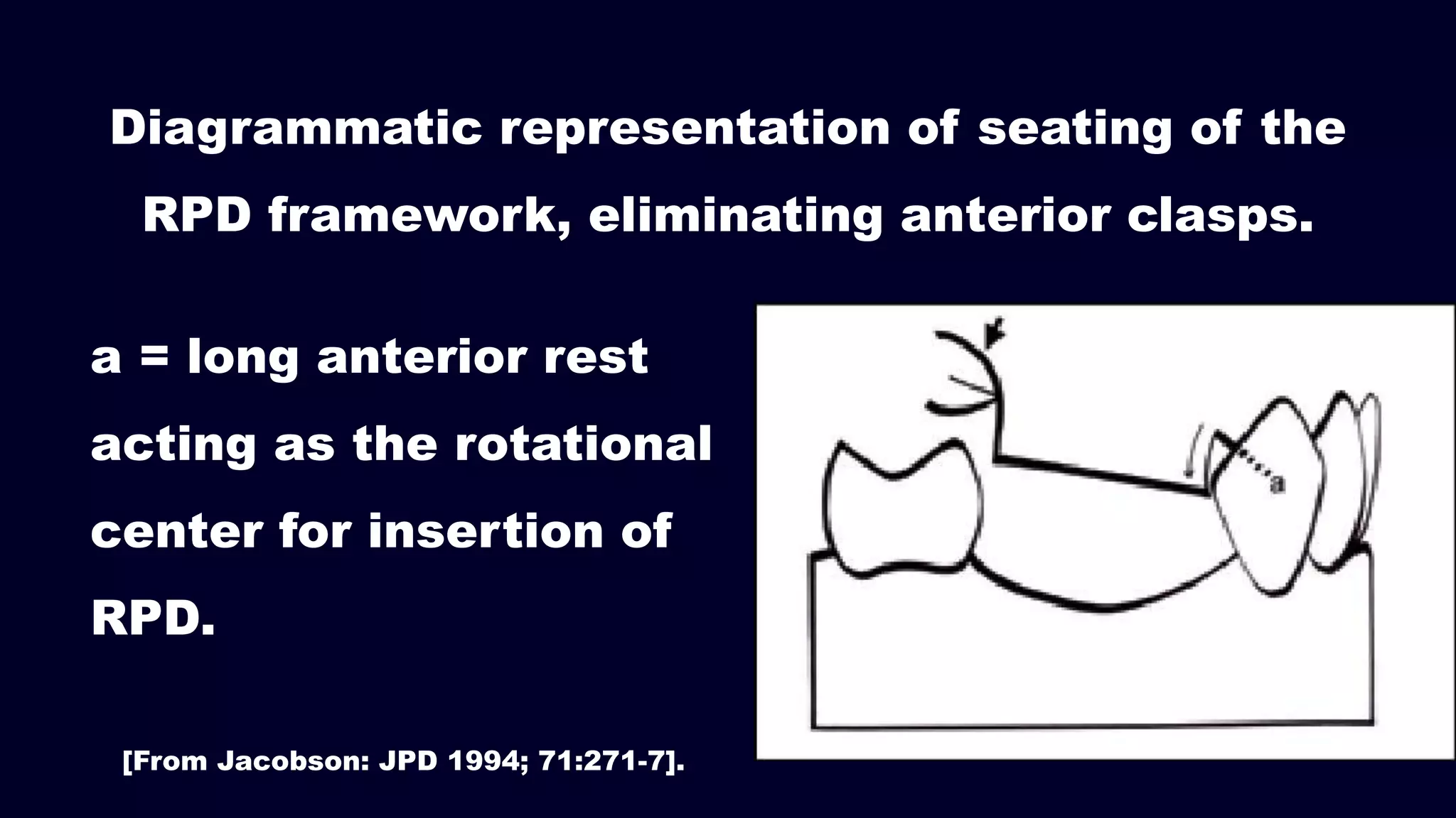 Diagrammatic representation of seating of the
RPD framework, eliminating anterior clasps.
[From Jacobson: JPD 1994; 71:271-7].
a = long anterior rest
acting as the rotational
center for insertion of
RPD.
 