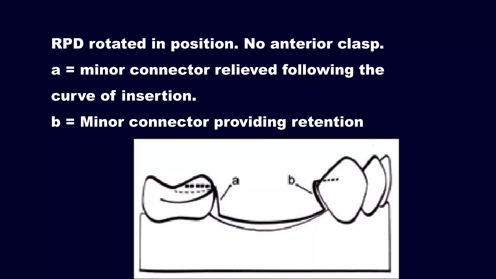 RPD rotated in position. No anterior clasp.
a = minor connector relieved following the
curve of insertion.
b = Minor connector providing retention
 
