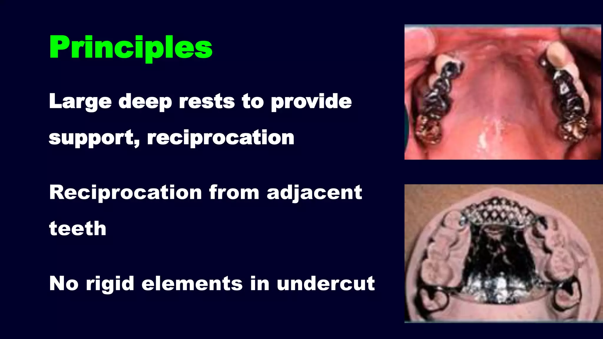 Large deep rests to provide
support, reciprocation
Reciprocation from adjacent
teeth
No rigid elements in undercut
Principles
 