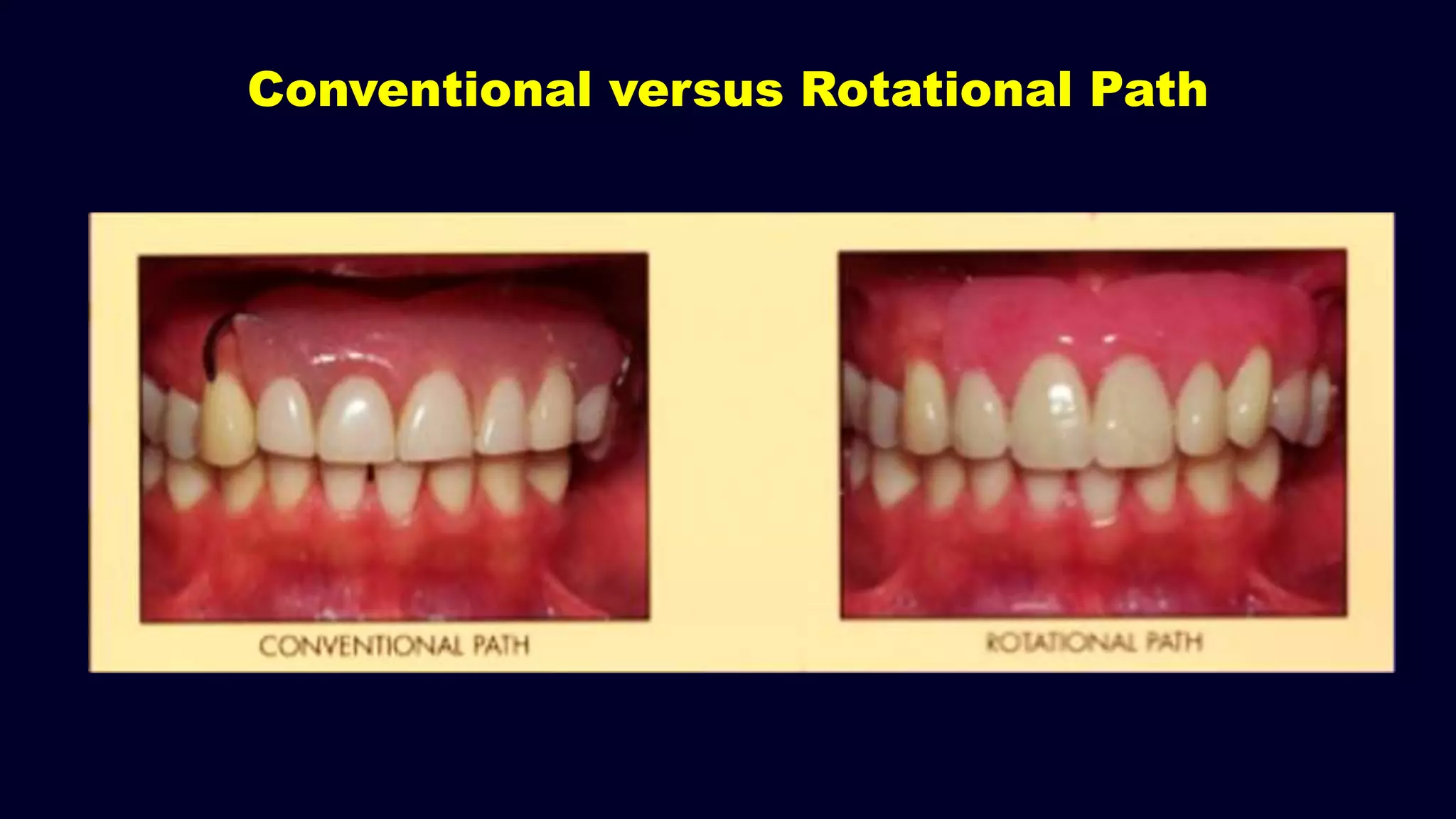Conventional versus Rotational Path
 