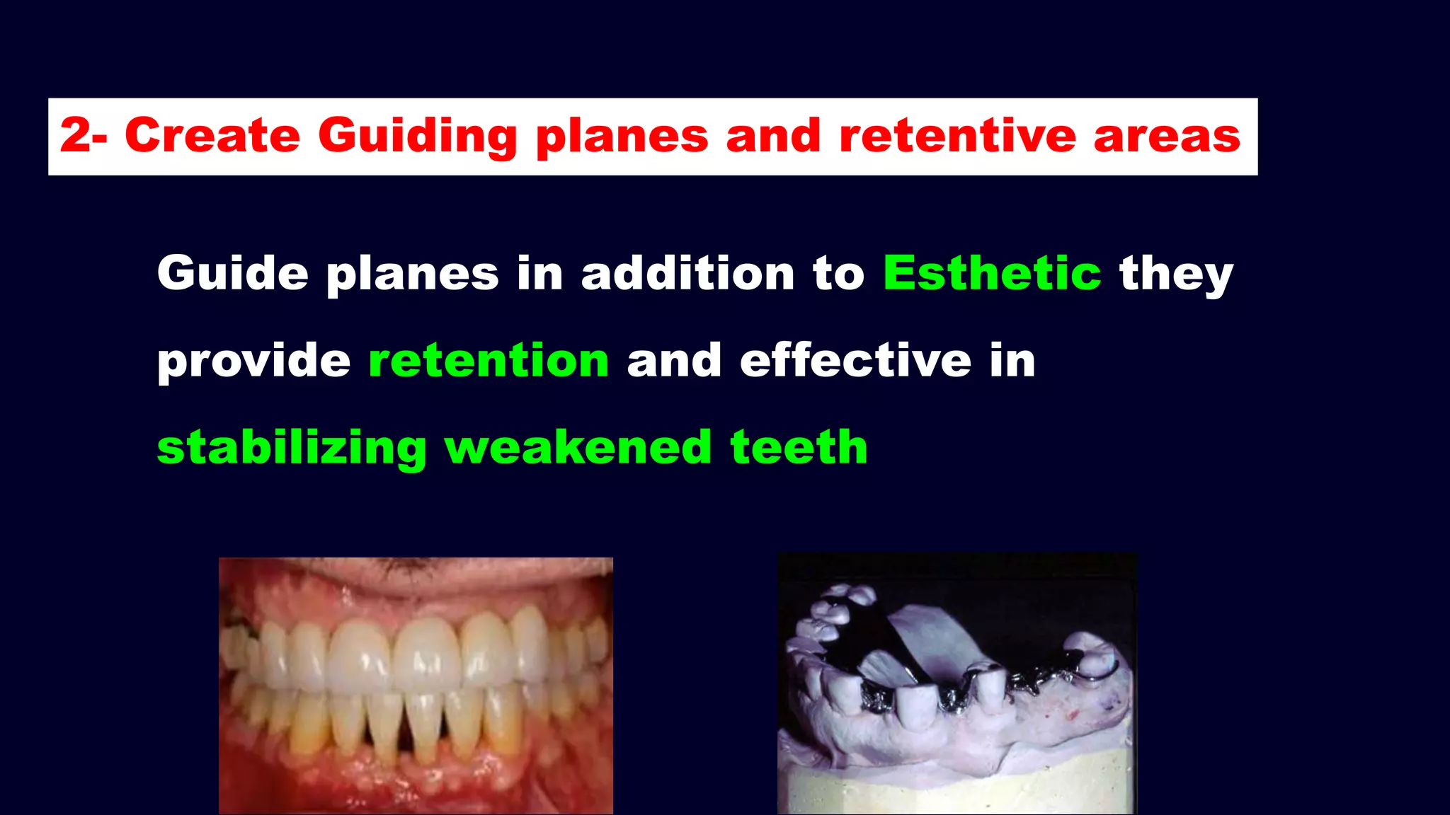 Guide planes in addition to Esthetic they
provide retention and effective in
stabilizing weakened teeth
2- Create Guiding planes and retentive areas
 