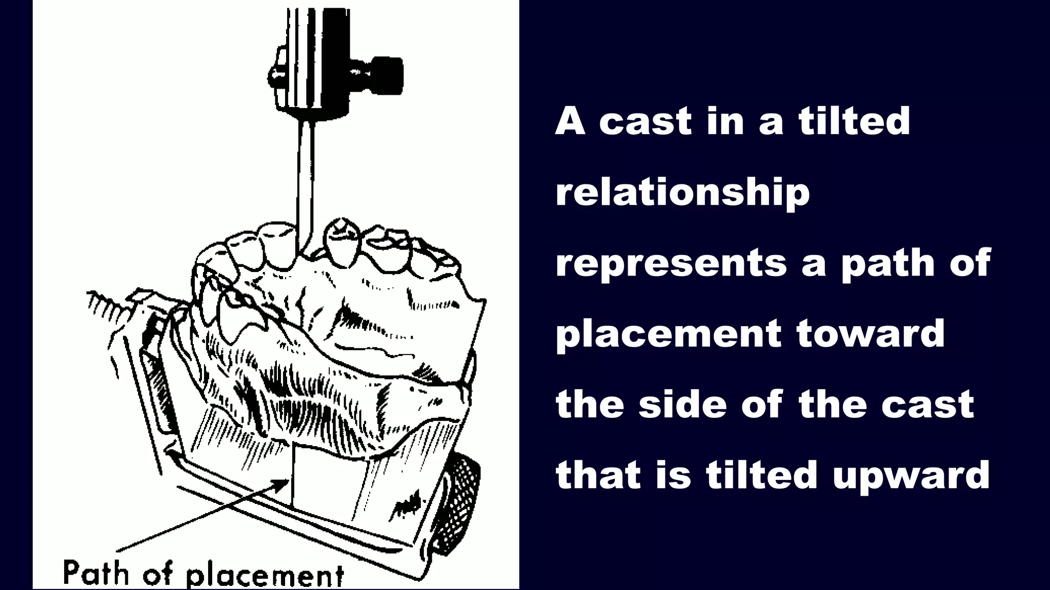 A cast in a tilted
relationship
represents a path of
placement toward
the side of the cast
that is tilted upward
 
