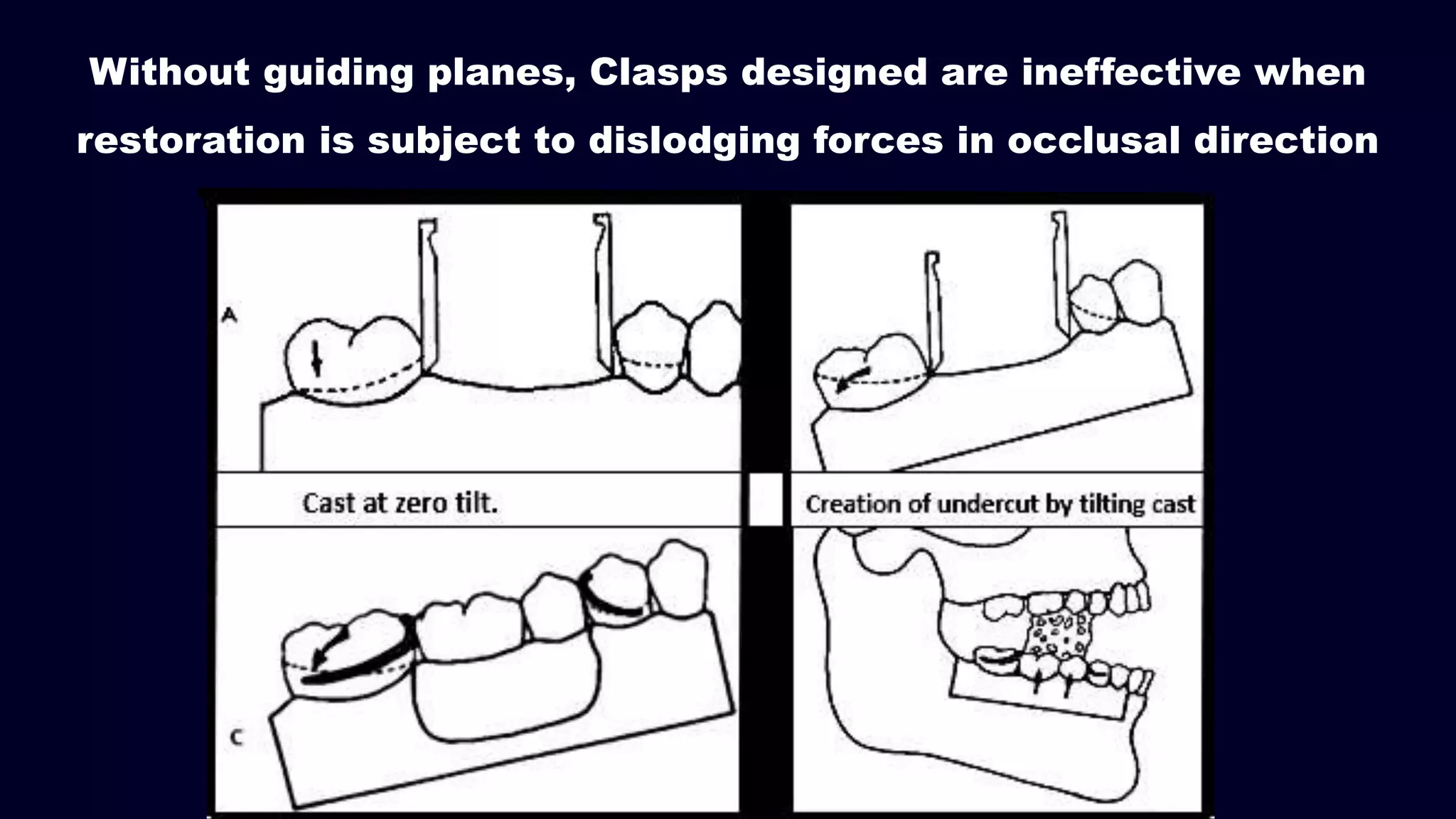 Without guiding planes, Clasps designed are ineffective when
restoration is subject to dislodging forces in occlusal direction
 