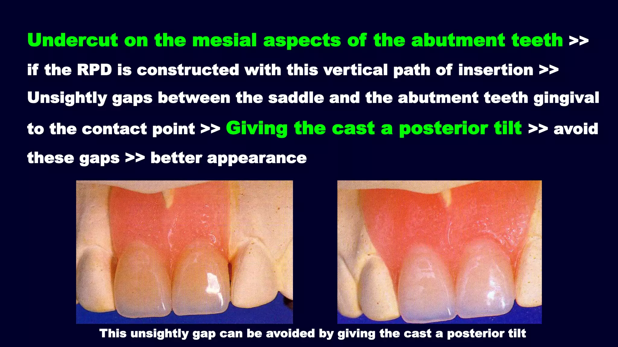 Undercut on the mesial aspects of the abutment teeth >>
if the RPD is constructed with this vertical path of insertion >>
Unsightly gaps between the saddle and the abutment teeth gingival
to the contact point >> Giving the cast a posterior tilt >> avoid
these gaps >> better appearance
This unsightly gap can be avoided by giving the cast a posterior tilt
 