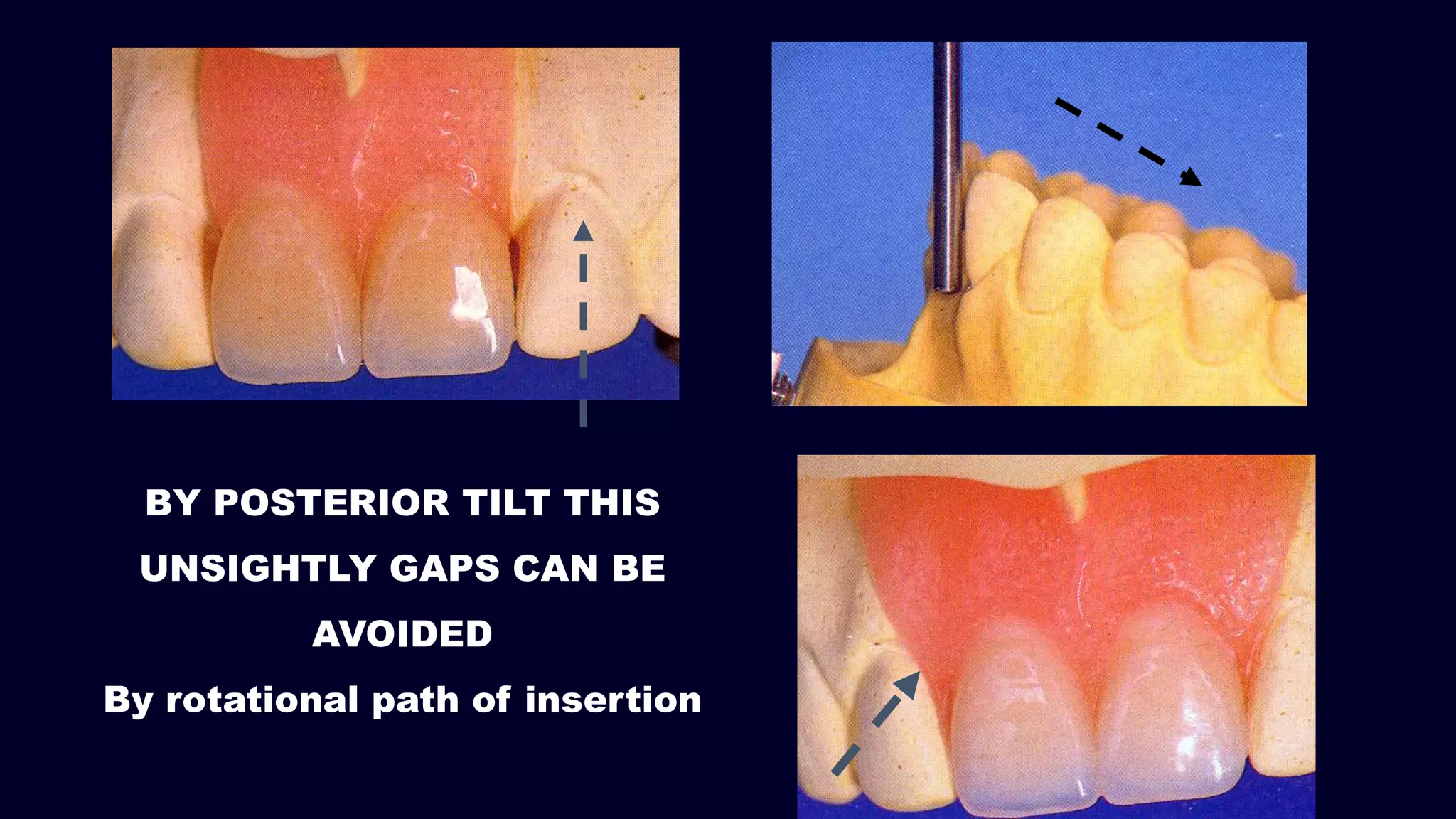 BY POSTERIOR TILT THIS
UNSIGHTLY GAPS CAN BE
AVOIDED
By rotational path of insertion
 
