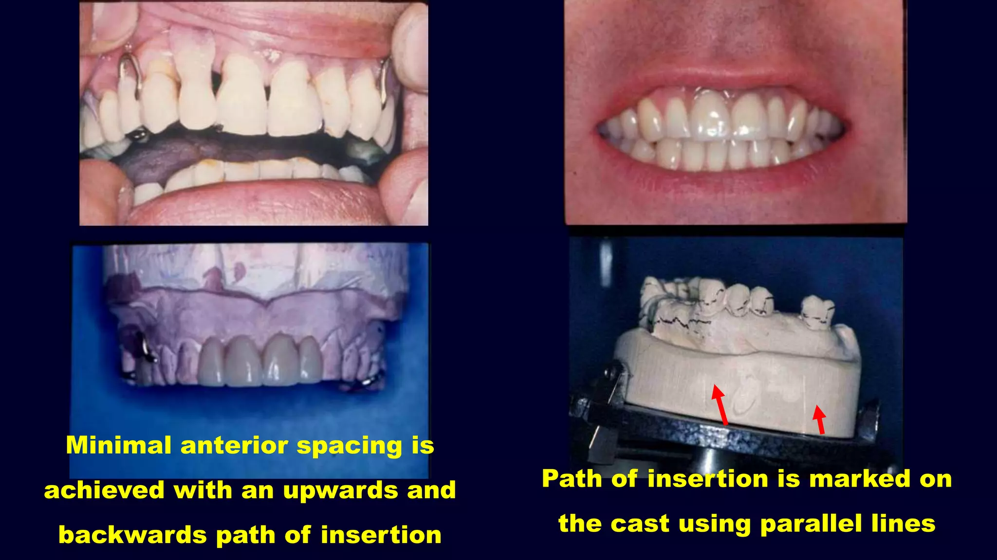 Path of insertion is marked on
the cast using parallel lines
Minimal anterior spacing is
achieved with an upwards and
backwards path of insertion
 