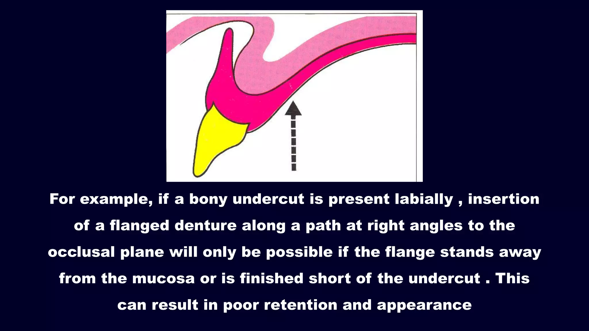 For example, if a bony undercut is present labially , insertion
of a flanged denture along a path at right angles to the
occlusal plane will only be possible if the flange stands away
from the mucosa or is finished short of the undercut . This
can result in poor retention and appearance
 