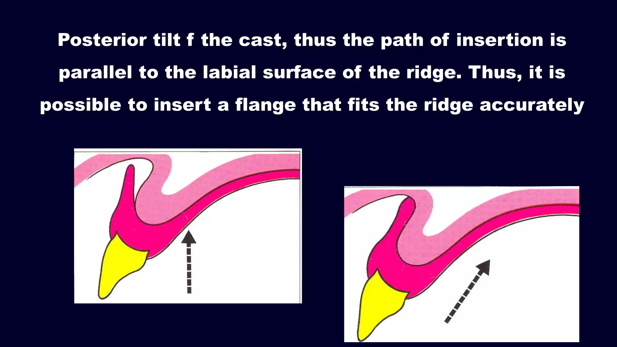 Posterior tilt f the cast, thus the path of insertion is
parallel to the labial surface of the ridge. Thus, it is
possible to insert a flange that fits the ridge accurately
 