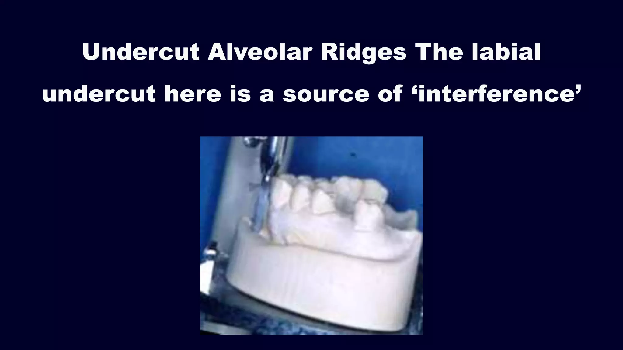 Undercut Alveolar Ridges The labial
undercut here is a source of ‘interference’
 