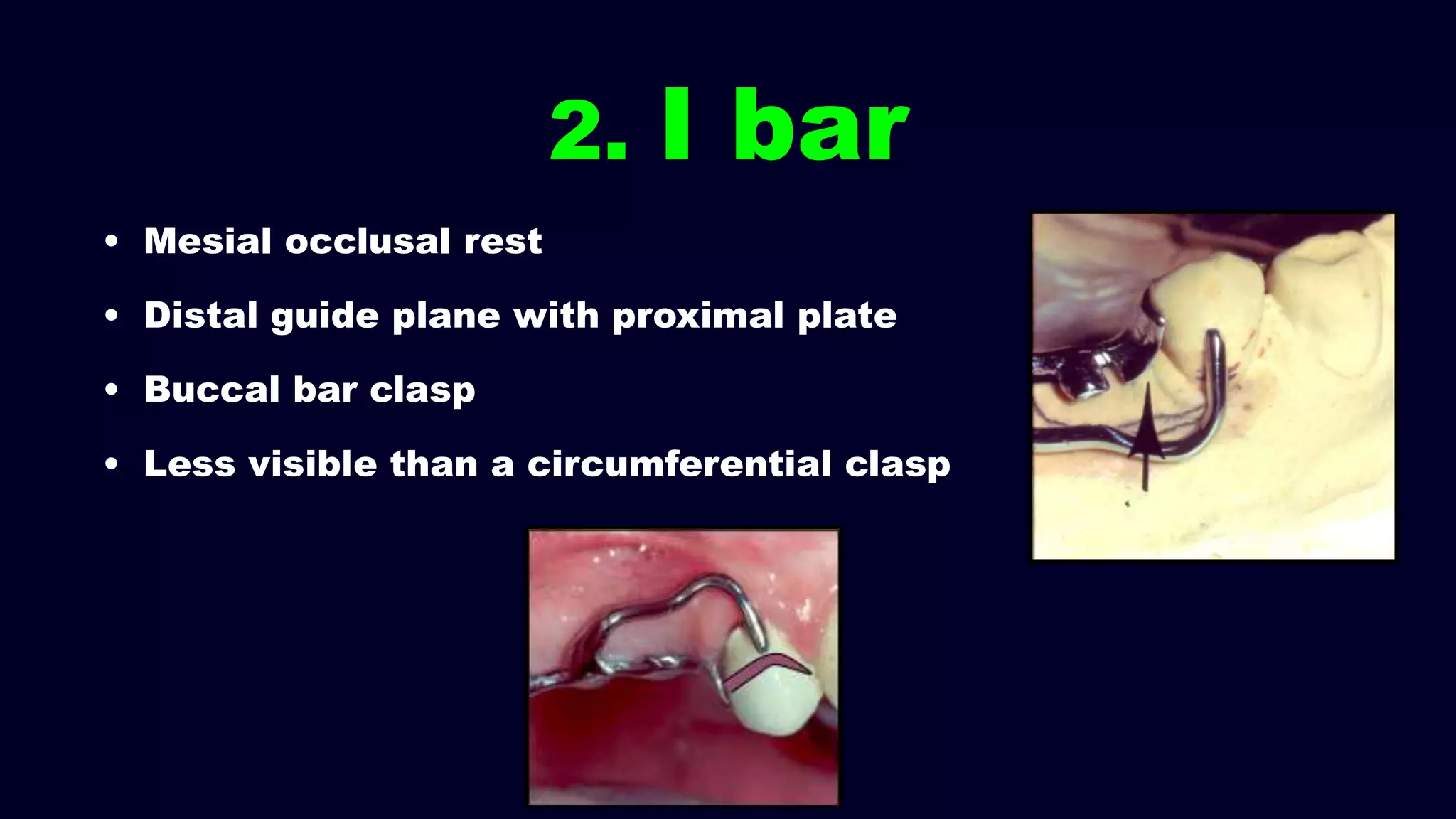 2. I bar
• Mesial occlusal rest
• Distal guide plane with proximal plate
• Buccal bar clasp
• Less visible than a circumferential clasp
 