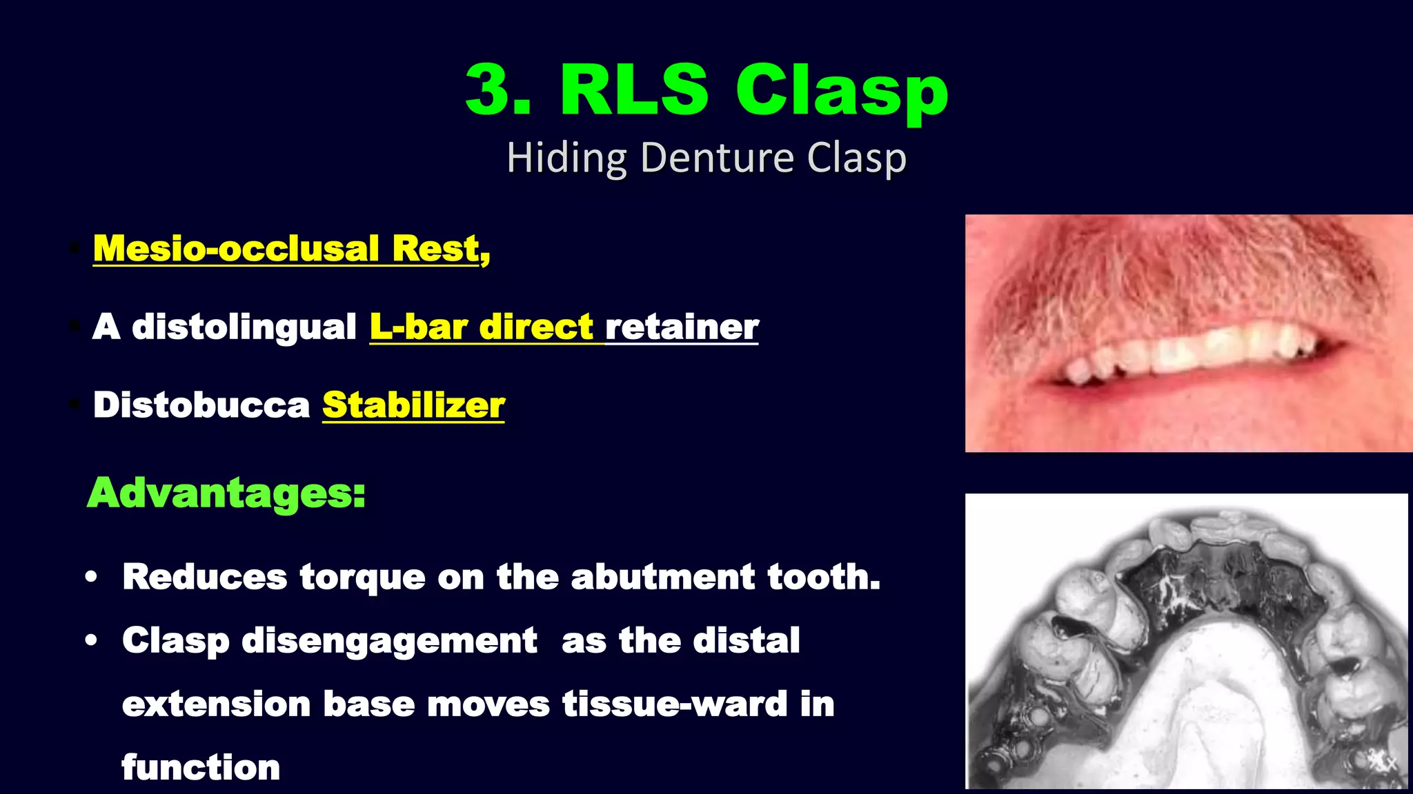 3. RLS Clasp
 Mesio-occlusal Rest,
 A distolingual L-bar direct retainer
 Distobucca Stabilizer
Advantages:
• Reduces torque on the abutment tooth.
• Clasp disengagement as the distal
extension base moves tissue-ward in
function
Hiding Denture Clasp
 