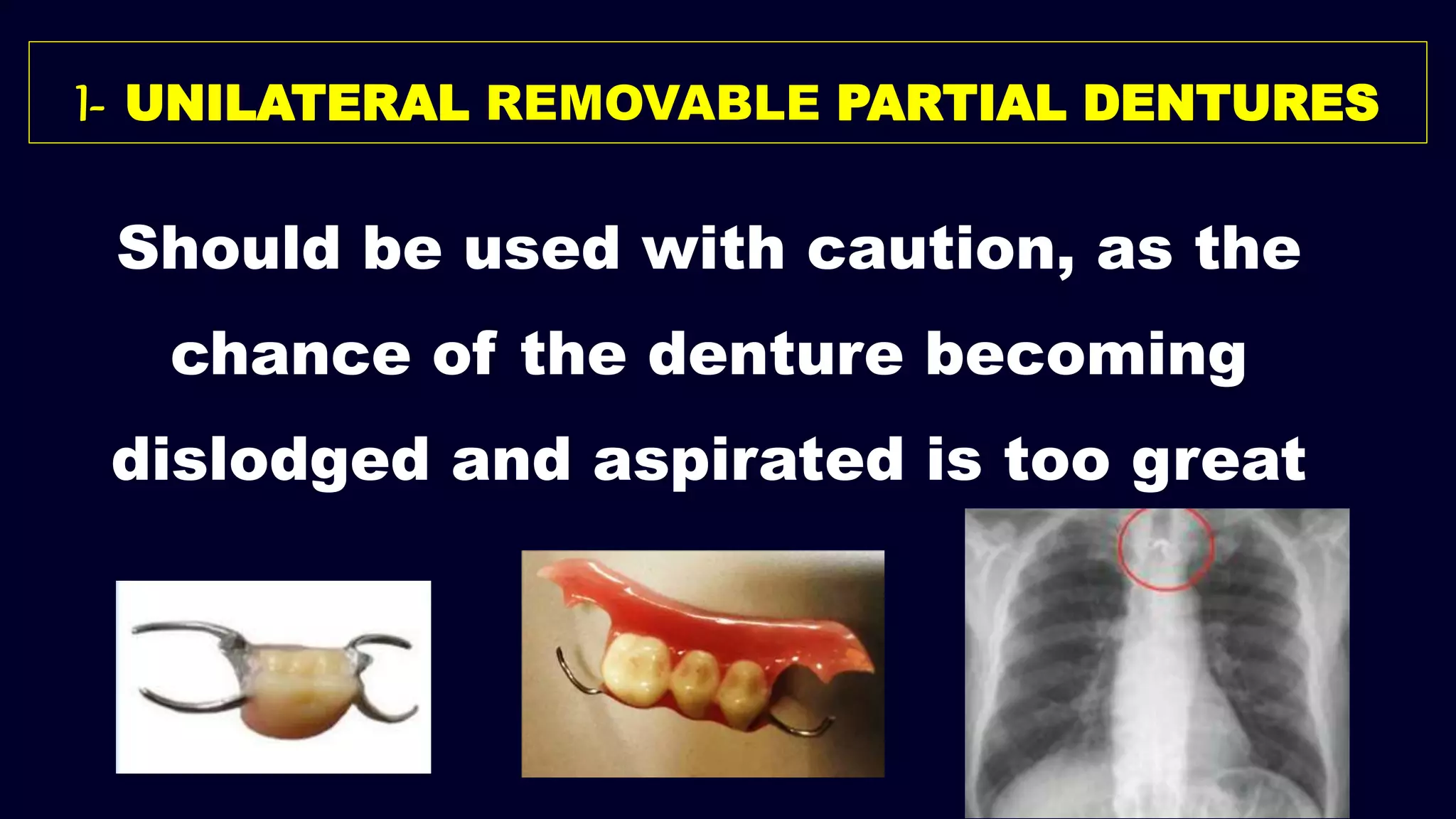 Should be used with caution, as the
chance of the denture becoming
dislodged and aspirated is too great
I- UNILATERAL REMOVABLE PARTIAL DENTURES
 