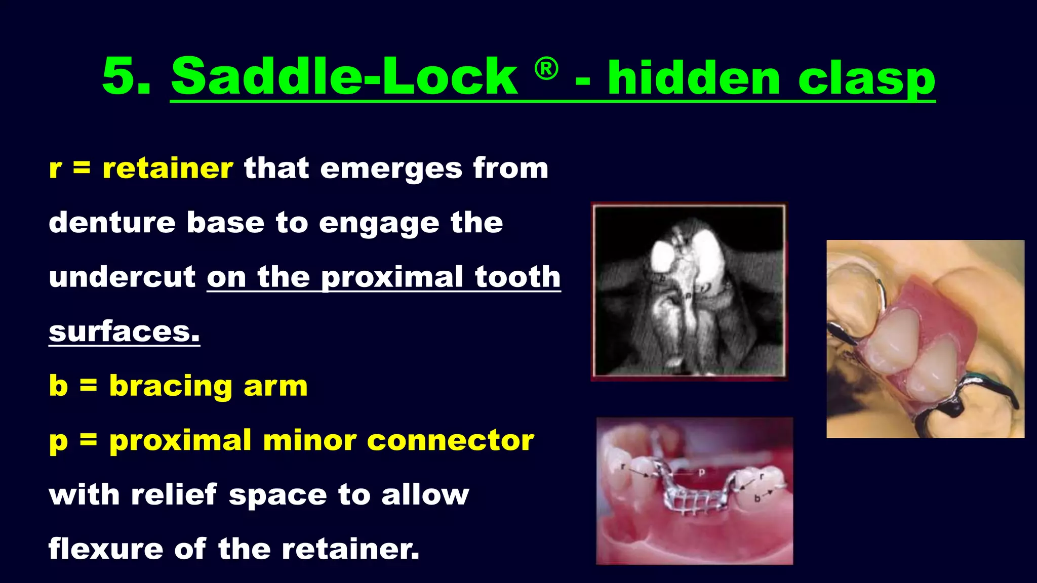 5. Saddle-Lock ® - hidden clasp
r = retainer that emerges from
denture base to engage the
undercut on the proximal tooth
surfaces.
b = bracing arm
p = proximal minor connector
with relief space to allow
flexure of the retainer.
 