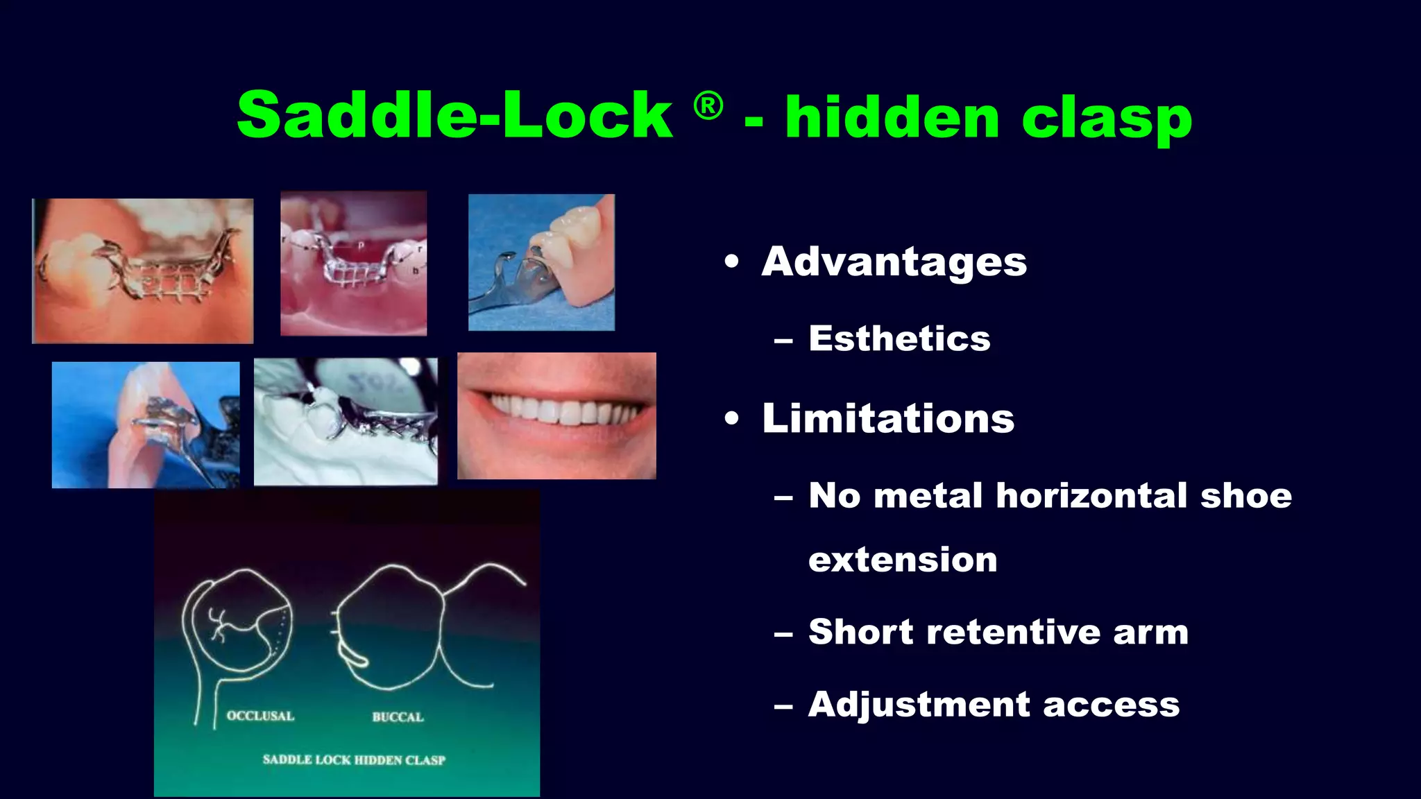 Saddle-Lock ® - hidden clasp
• Advantages
– Esthetics
• Limitations
– No metal horizontal shoe
extension
– Short retentive arm
– Adjustment access
 