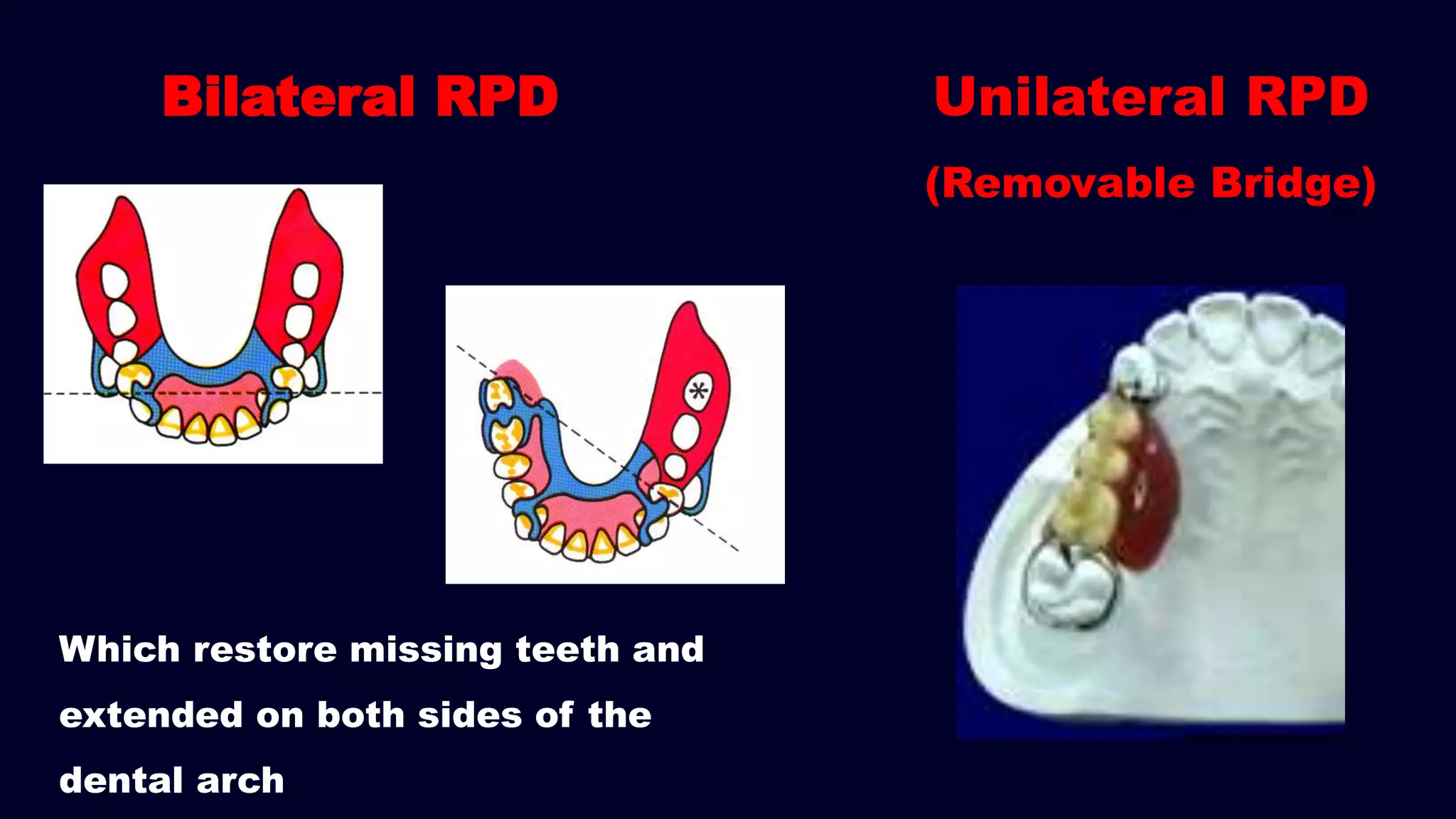 Bilateral RPD Unilateral RPD
(Removable Bridge)
Which restore missing teeth and
extended on both sides of the
dental arch
 