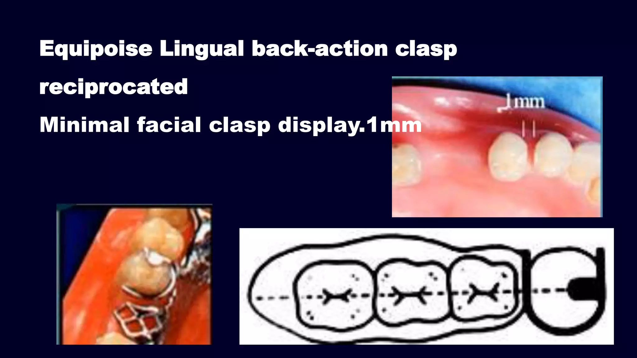Equipoise Lingual back-action clasp
reciprocated
Minimal facial clasp display.1mm
 