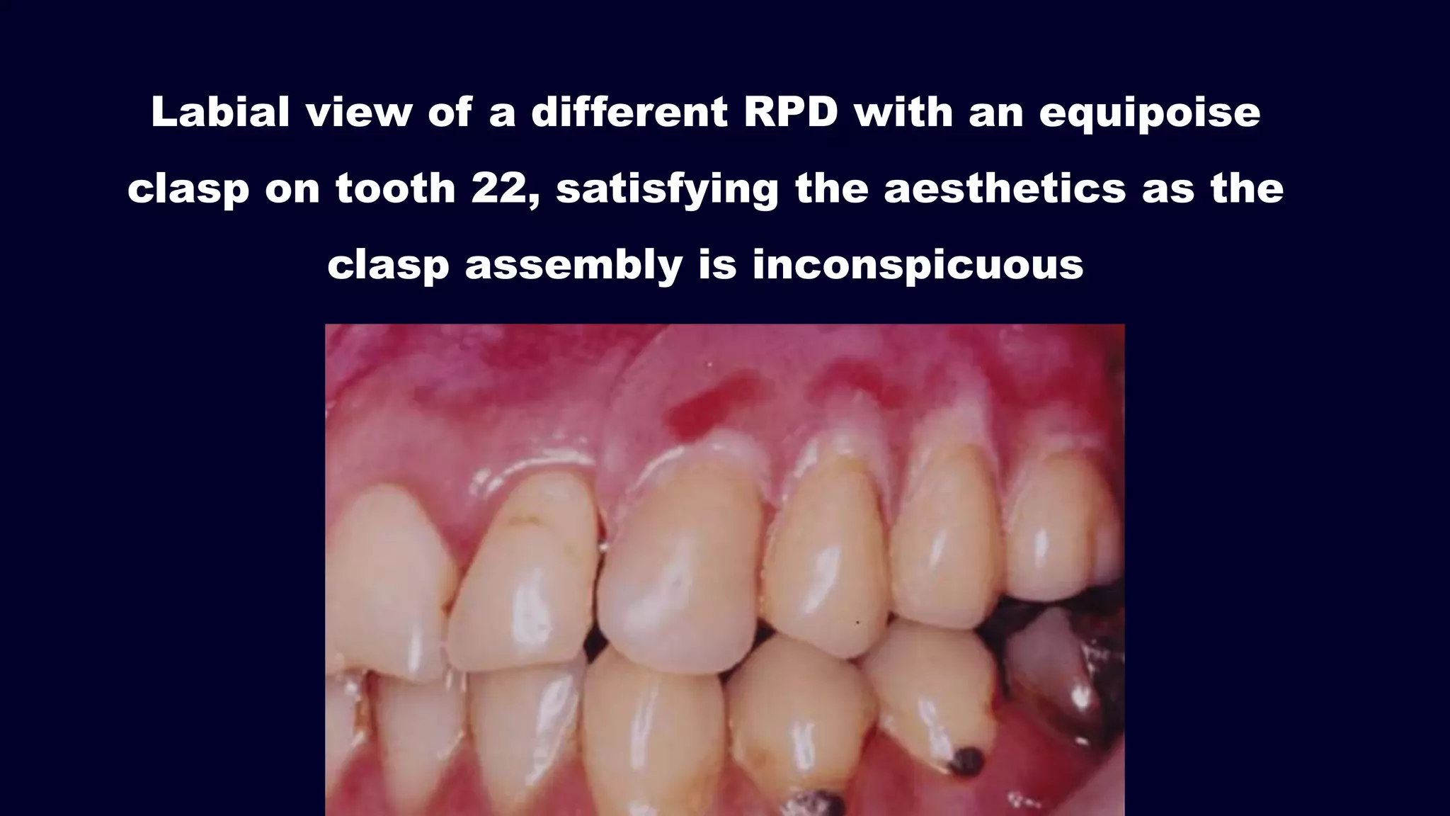 Labial view of a different RPD with an equipoise
clasp on tooth 22, satisfying the aesthetics as the
clasp assembly is inconspicuous
 