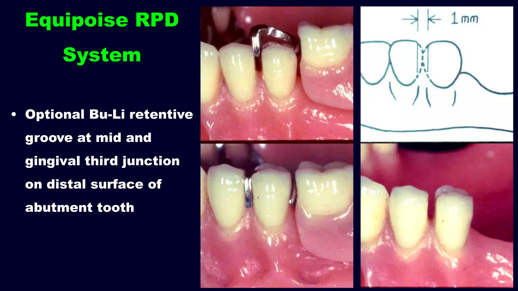 • Optional Bu-Li retentive
groove at mid and
gingival third junction
on distal surface of
abutment tooth
Equipoise RPD
System
 