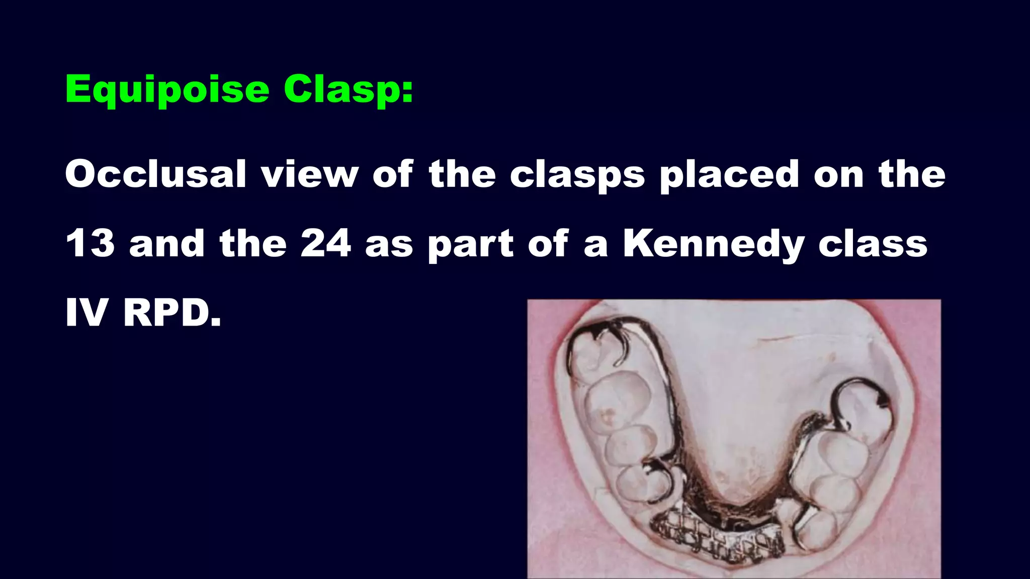 Occlusal view of the clasps placed on the
13 and the 24 as part of a Kennedy class
IV RPD.
Equipoise Clasp:
 
