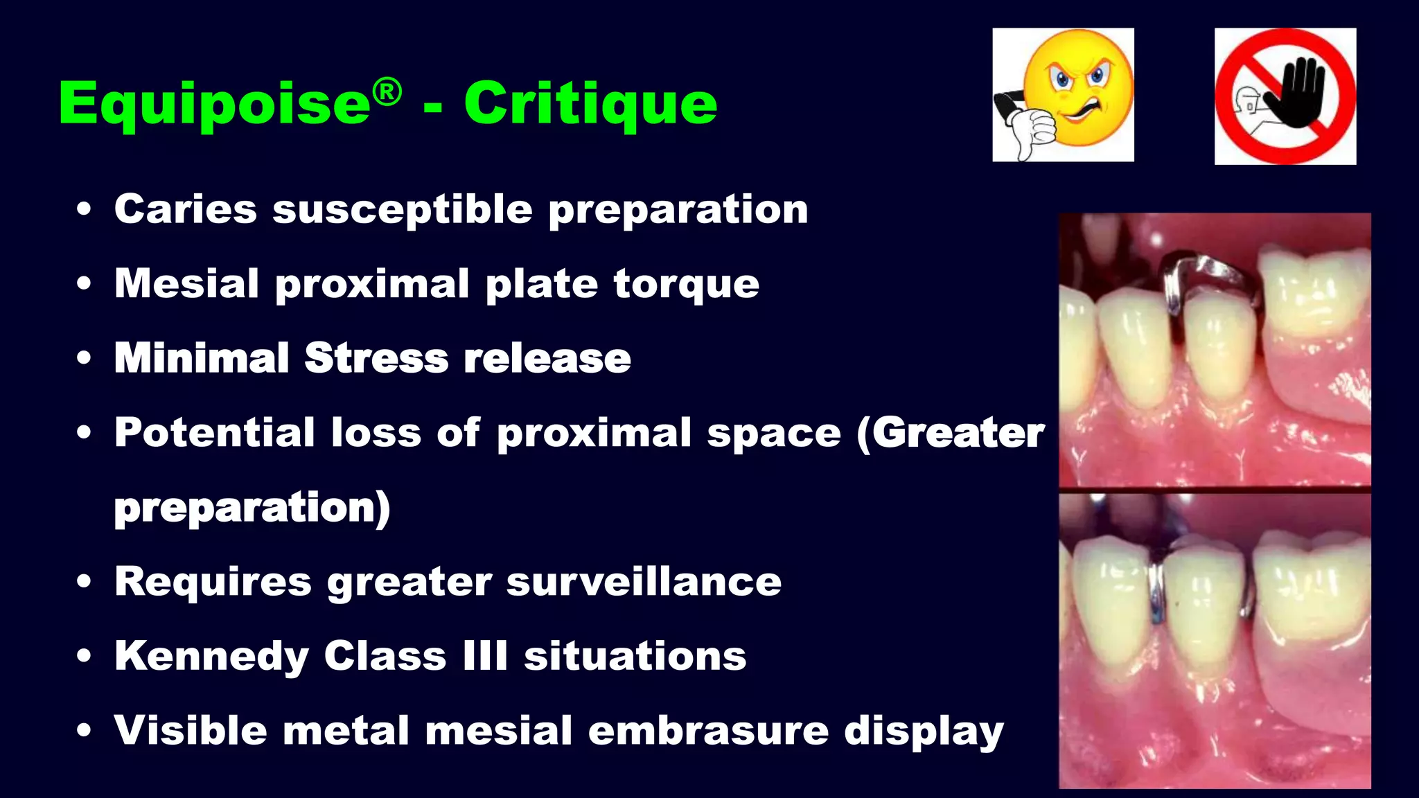 Equipoise® - Critique
• Caries susceptible preparation
• Mesial proximal plate torque
• Minimal Stress release
• Potential loss of proximal space (Greater
preparation)
• Requires greater surveillance
• Kennedy Class III situations
• Visible metal mesial embrasure display
 
