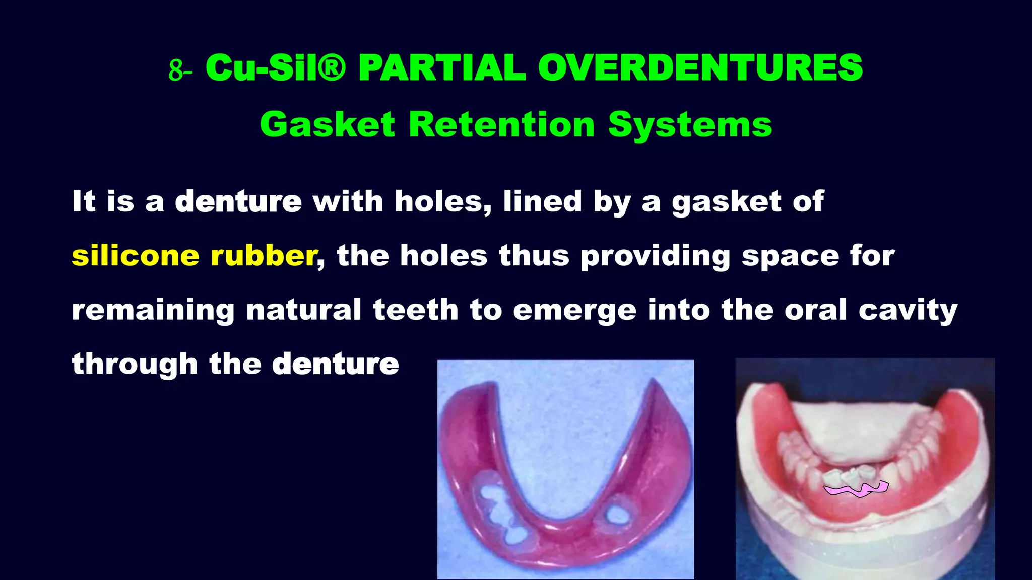 It is a denture with holes, lined by a gasket of
silicone rubber, the holes thus providing space for
remaining natural teeth to emerge into the oral cavity
through the denture
8- Cu-Sil® PARTIAL OVERDENTURES
Gasket Retention Systems
 