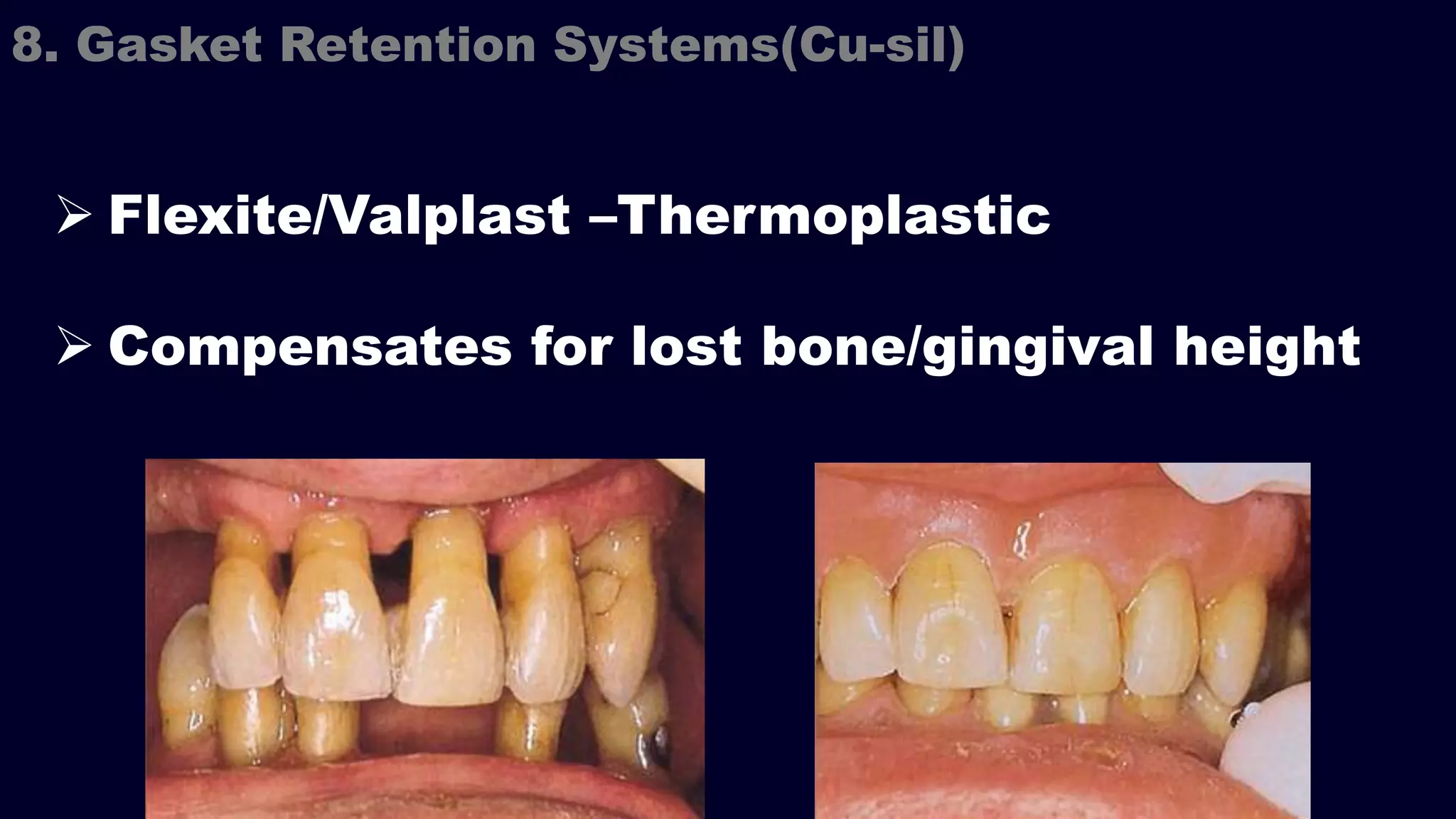  Flexite/Valplast –Thermoplastic
 Compensates for lost bone/gingival height
8. Gasket Retention Systems(Cu-sil)
 