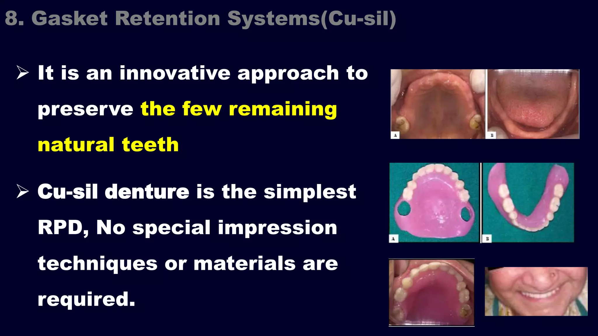 It is an innovative approach to
preserve the few remaining
natural teeth
 Cu-sil denture is the simplest
RPD, No special impression
techniques or materials are
required.
8. Gasket Retention Systems(Cu-sil)
 
