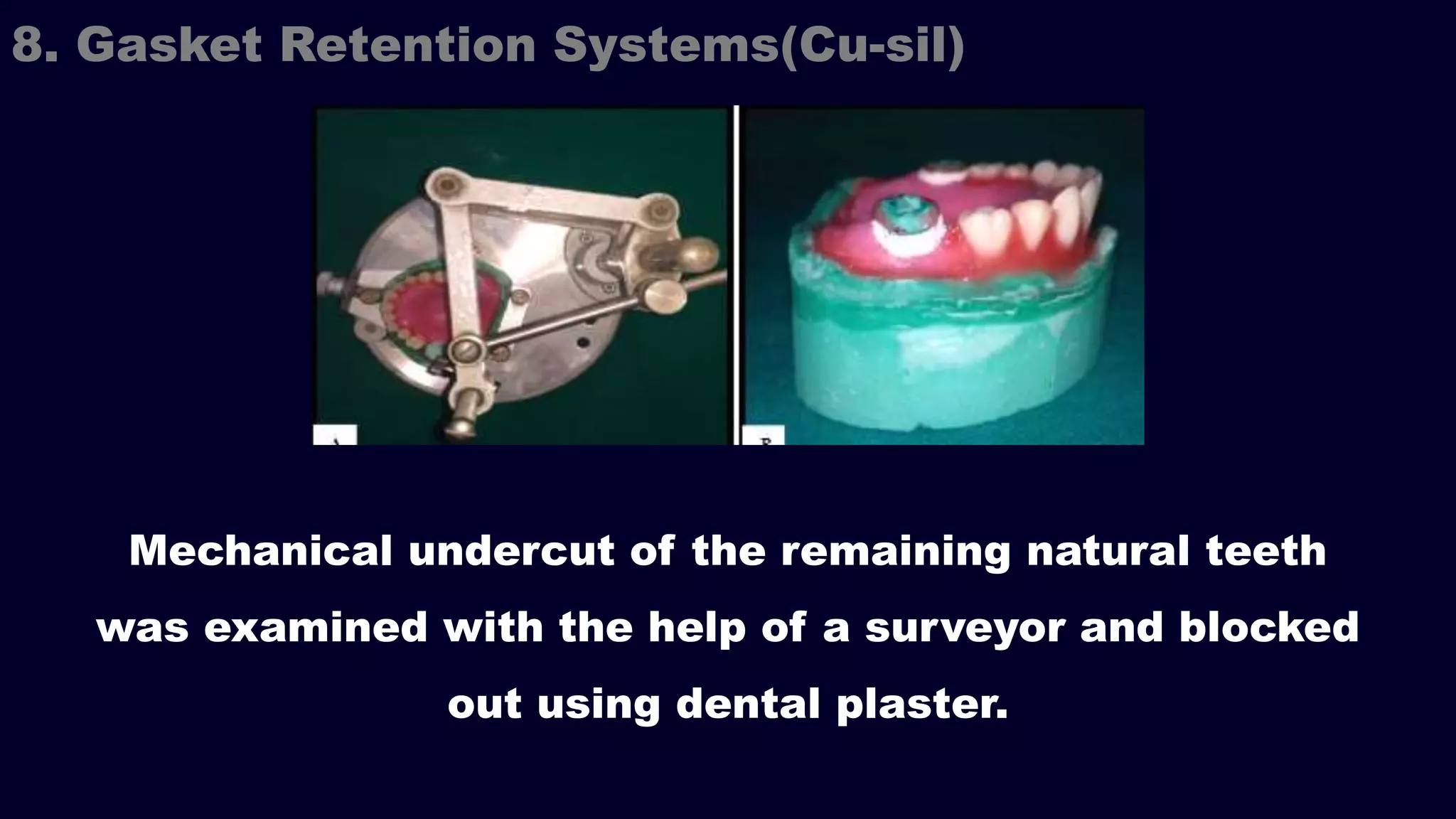 Mechanical undercut of the remaining natural teeth
was examined with the help of a surveyor and blocked
out using dental plaster.
8. Gasket Retention Systems(Cu-sil)
 