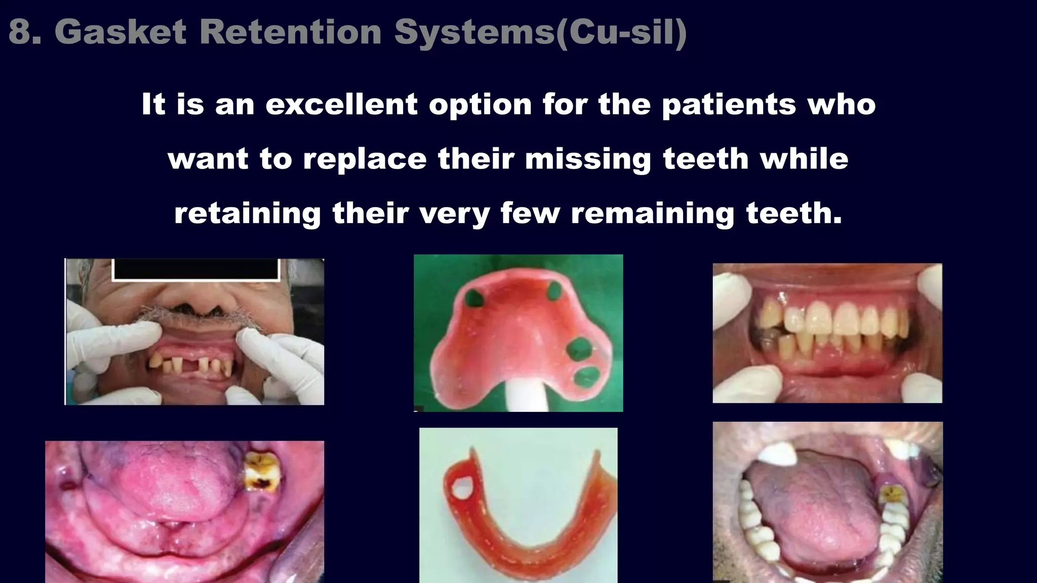 It is an excellent option for the patients who
want to replace their missing teeth while
retaining their very few remaining teeth.
8. Gasket Retention Systems(Cu-sil)
 