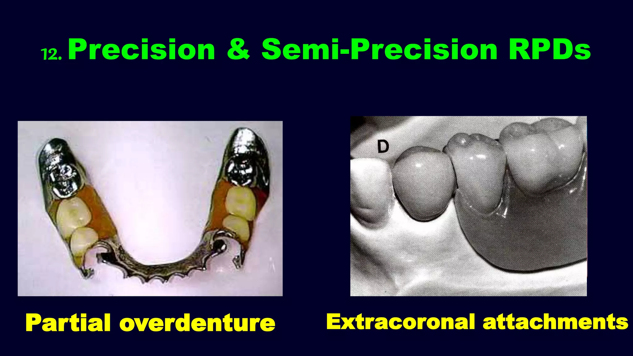 12. Precision & Semi-Precision RPDs
Partial overdenture Extracoronal attachments
 