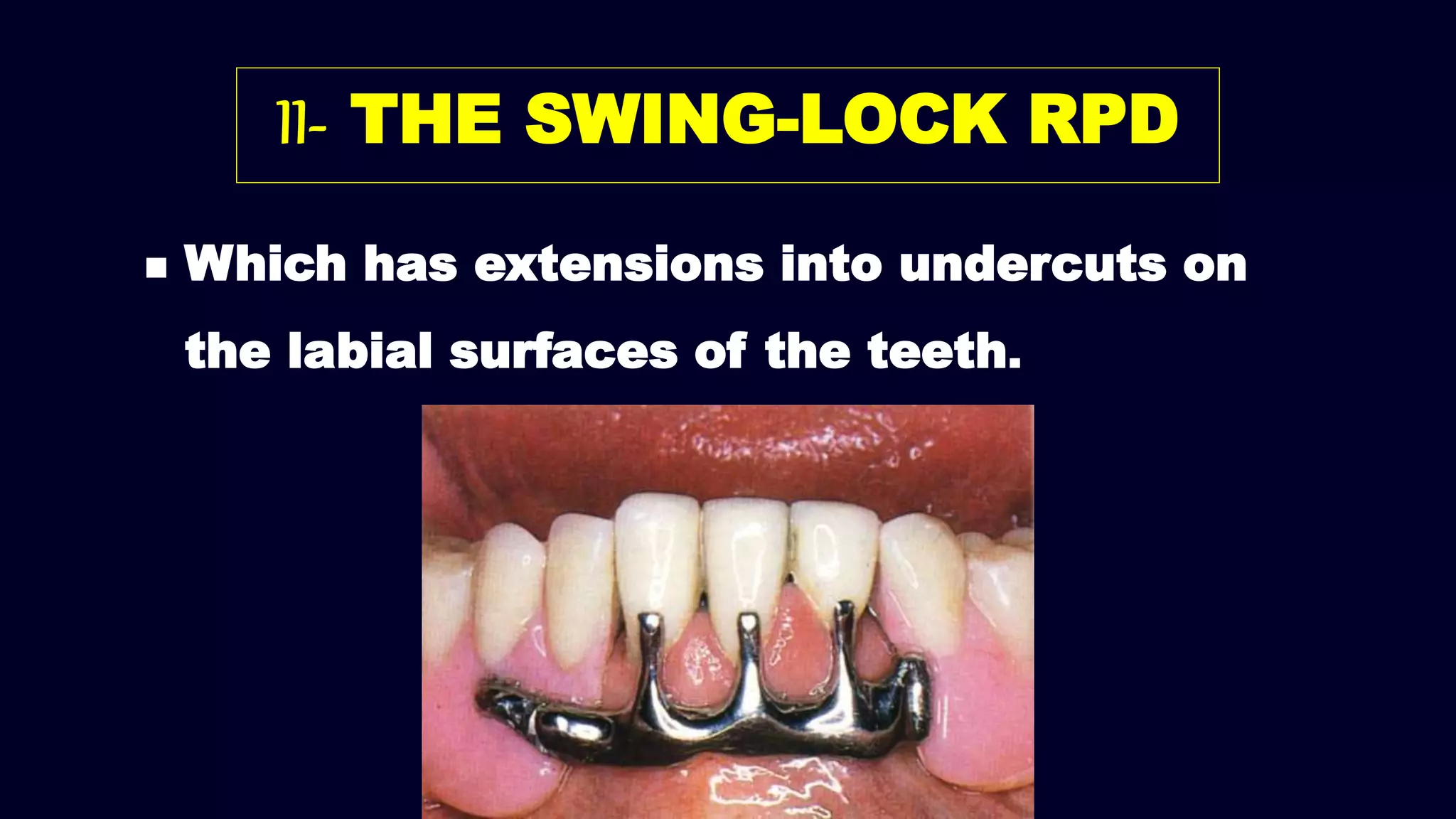  Which has extensions into undercuts on
the labial surfaces of the teeth.
II- THE SWING-LOCK RPD
 