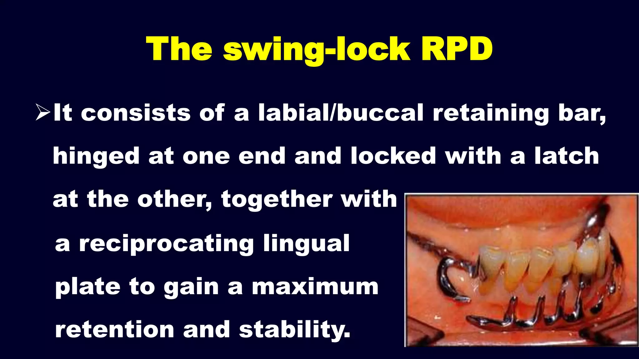 It consists of a labial/buccal retaining bar,
hinged at one end and locked with a latch
at the other, together with
The swing-lock RPD
a reciprocating lingual
plate to gain a maximum
retention and stability.
 