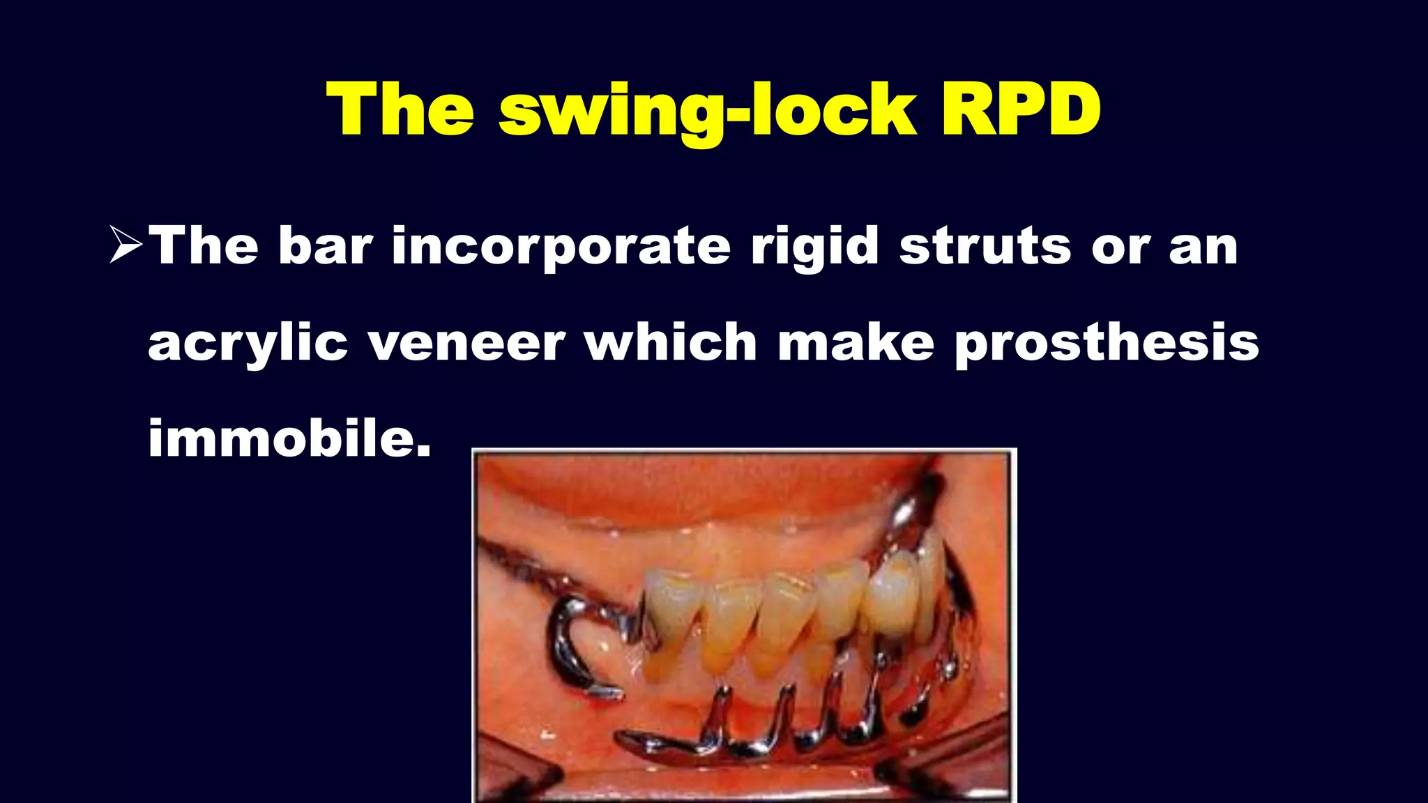 The bar incorporate rigid struts or an
acrylic veneer which make prosthesis
immobile.
The swing-lock RPD
 