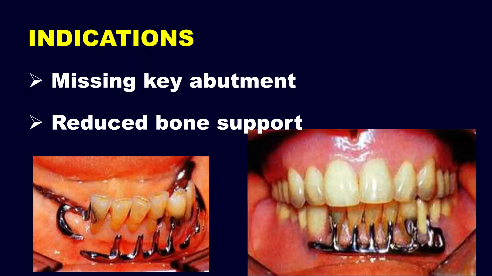 INDICATIONS
 Missing key abutment
 Reduced bone support
 