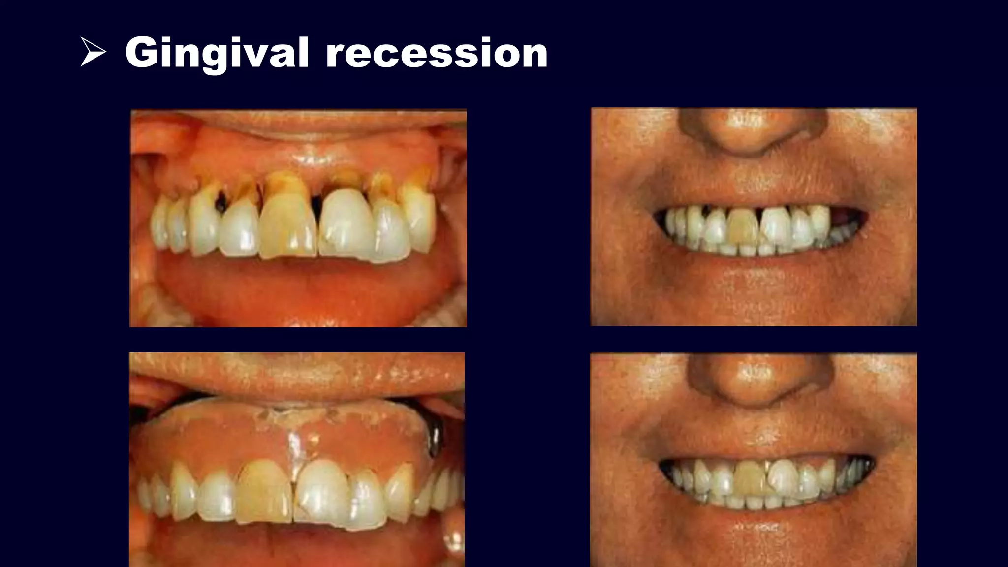  Gingival recession
 
