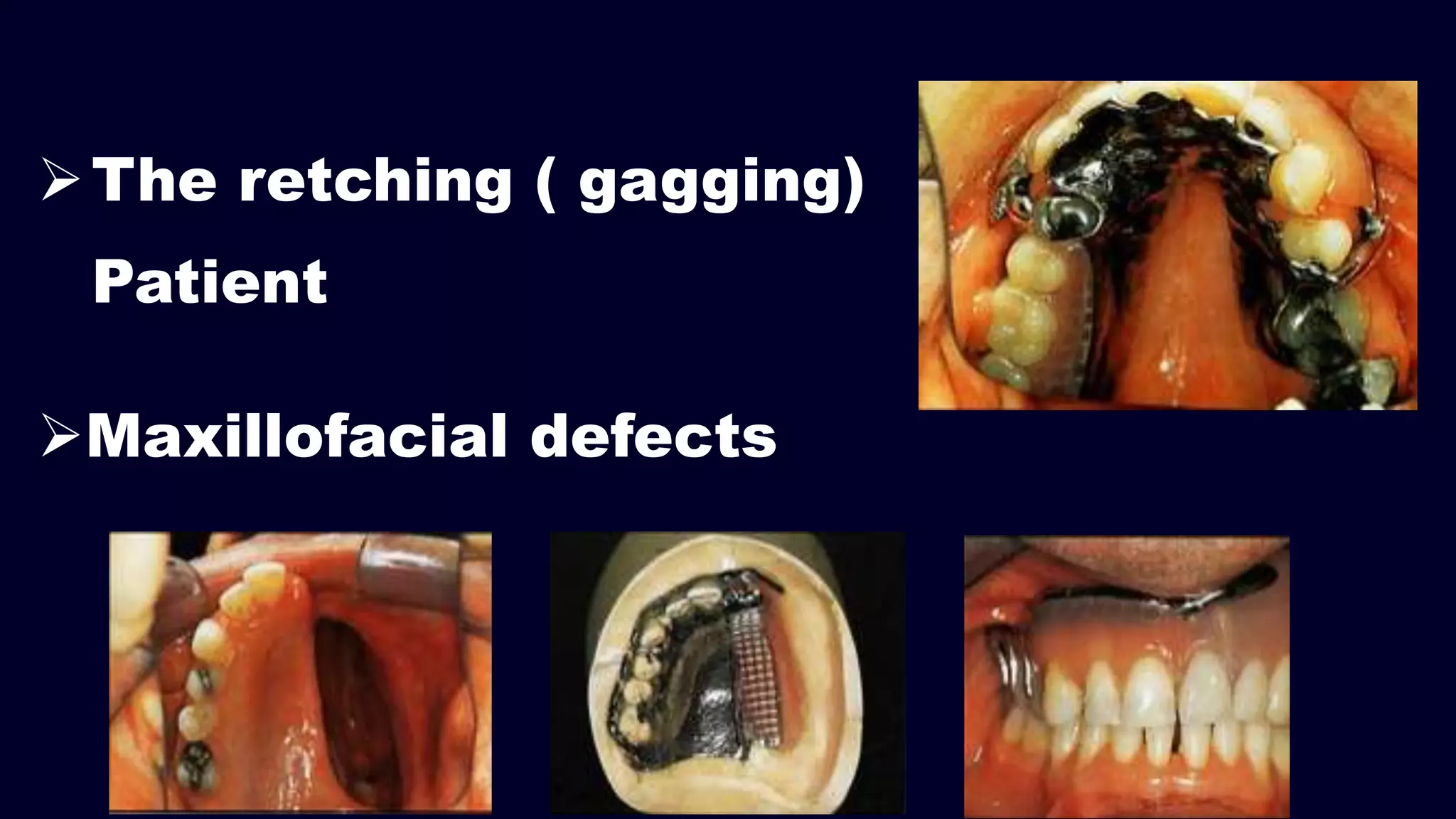 The retching ( gagging)
Patient
Maxillofacial defects
 