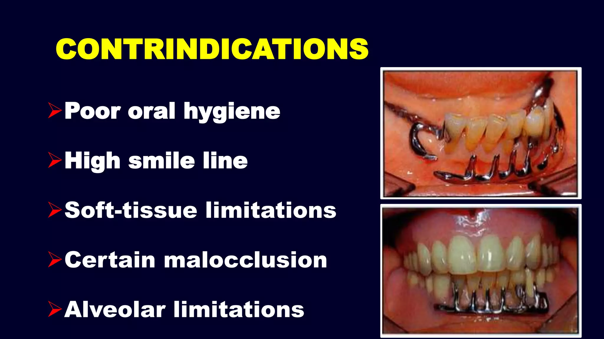 CONTRINDICATIONS
Poor oral hygiene
High smile line
Soft-tissue limitations
Certain malocclusion
Alveolar limitations
 