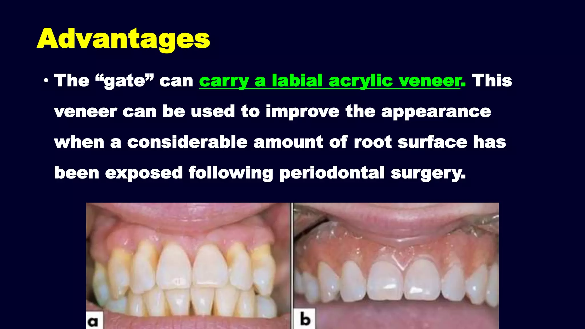 • The “gate” can carry a labial acrylic veneer. This
veneer can be used to improve the appearance
when a considerable amount of root surface has
been exposed following periodontal surgery.
Advantages
 