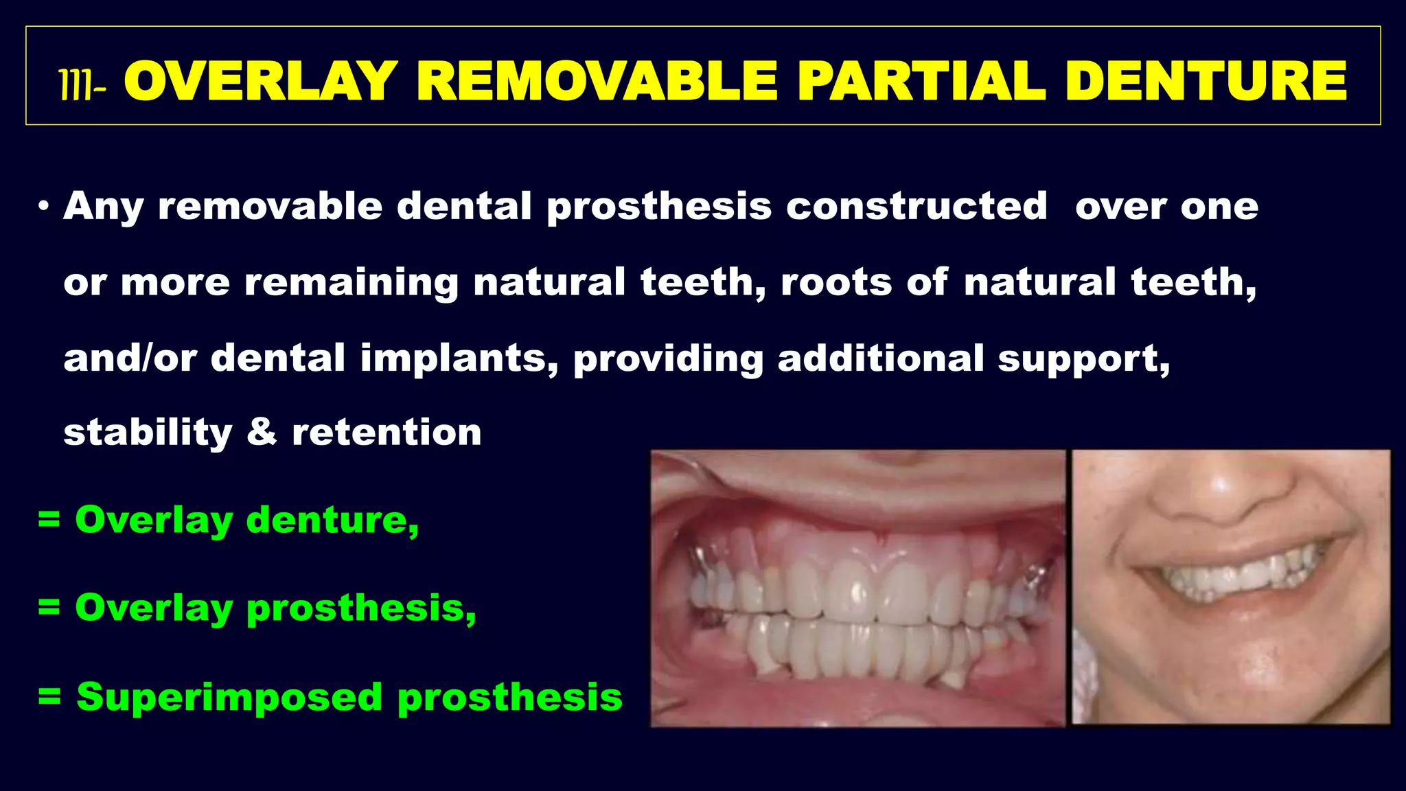 III- OVERLAY REMOVABLE PARTIAL DENTURE
• Any removable dental prosthesis constructed over one
or more remaining natural teeth, roots of natural teeth,
and/or dental implants, providing additional support,
stability & retention
= Overlay denture,
= Overlay prosthesis,
= Superimposed prosthesis
 