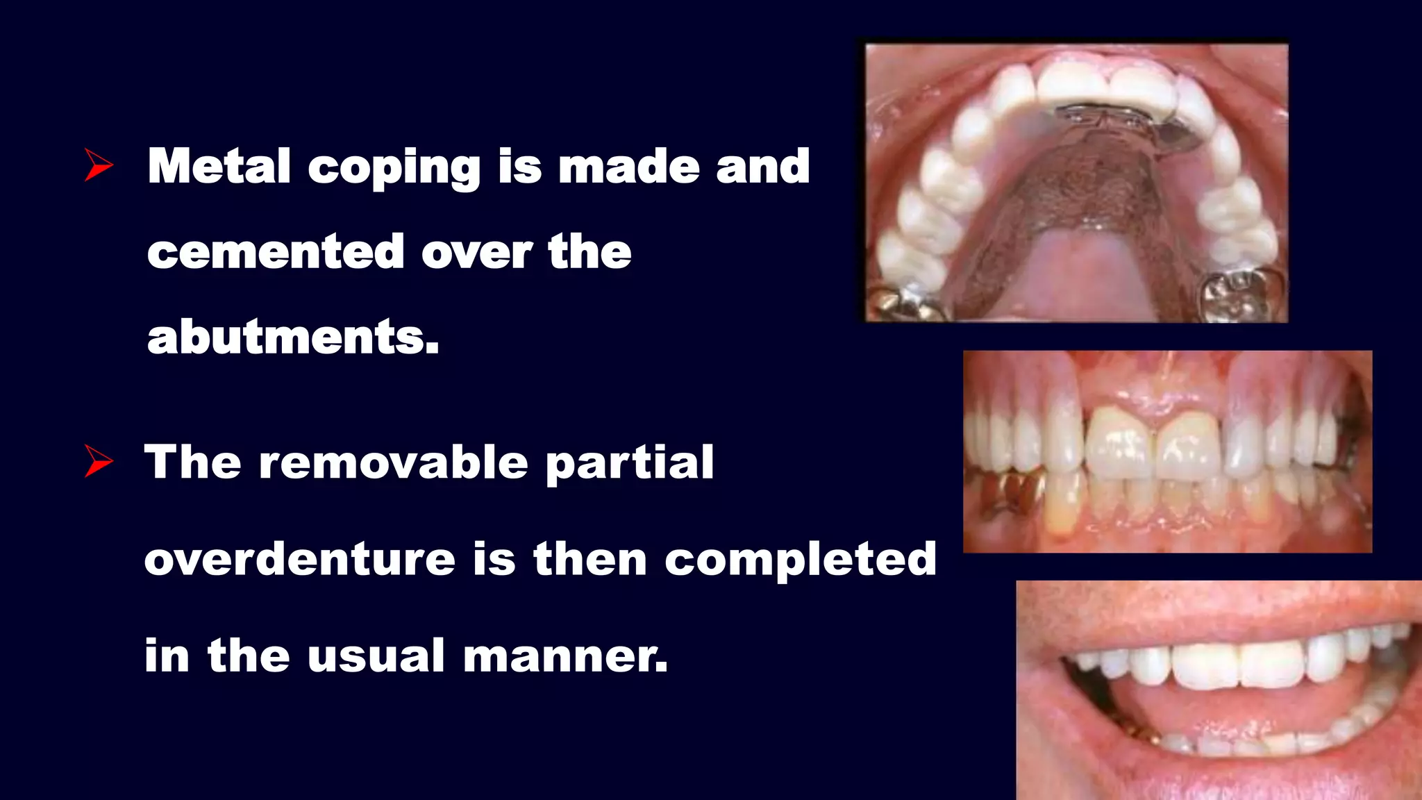 Metal coping is made and
cemented over the
abutments.
 The removable partial
overdenture is then completed
in the usual manner.
 